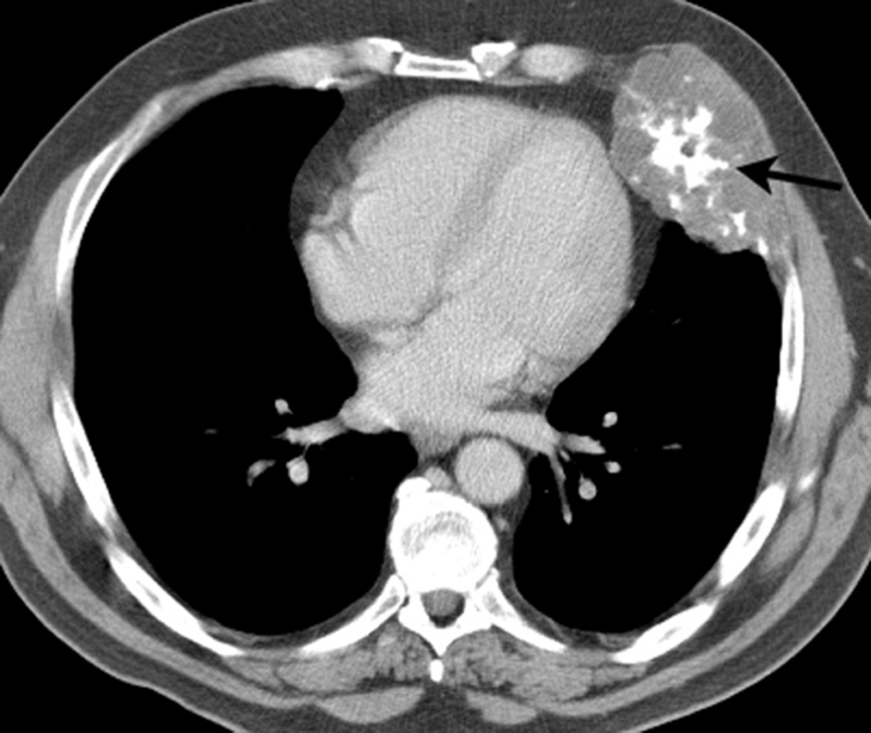 Axial CT. Chondrosarcoma of an anterior left rib demonstrating a large soft tissue component with internal punctuate calcification (arrow).