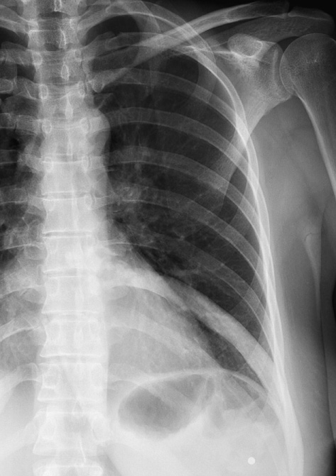 Fibrous dysplasia in a rib. CXR detail of the left lung. Compared with the other ribs the 9 th rib shows an increase in density and is slightly broadened. *