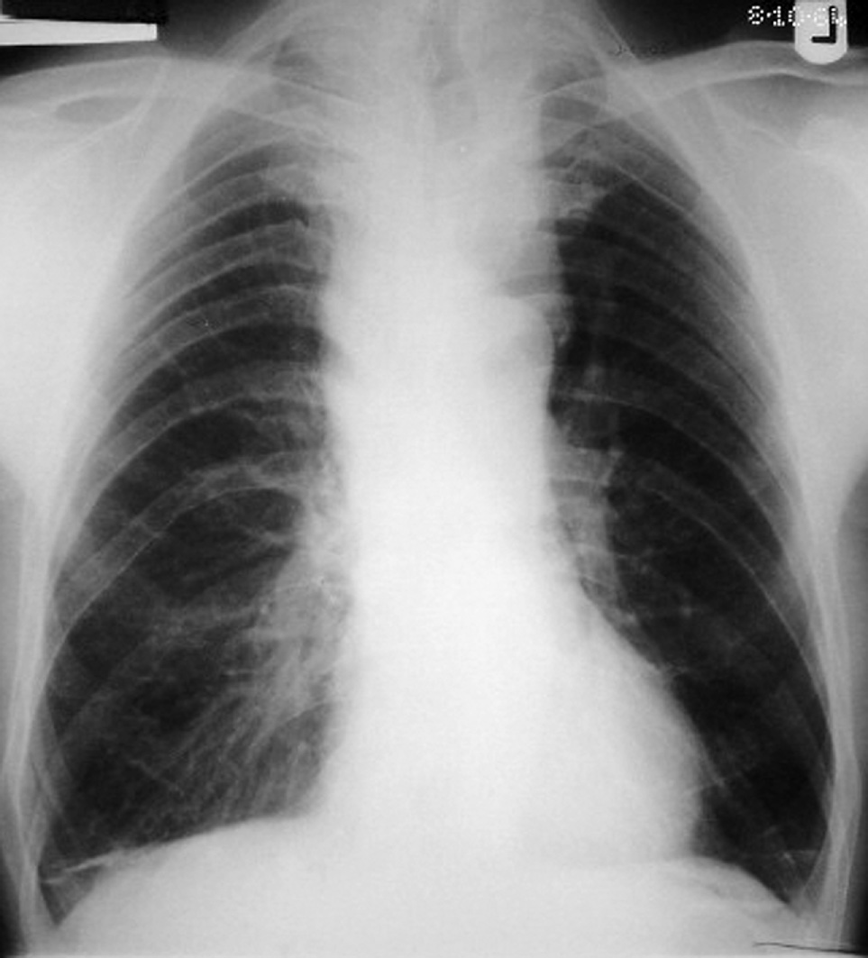 Chest radiograph in a patient with coarctation. There is rib notching and enlargement of the left subclavian artery, causing a ‘3’ sign.