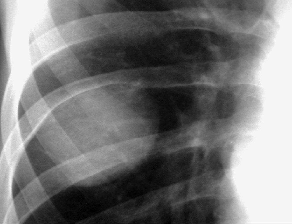 Neurofibromatosis type 1 (NF-1): skeletal findings. Pressure erosion of a rib due to a neurofibroma. (Most rib deformities in NF-1 are due to the skeletal dysplasia, not pressure erosion.)