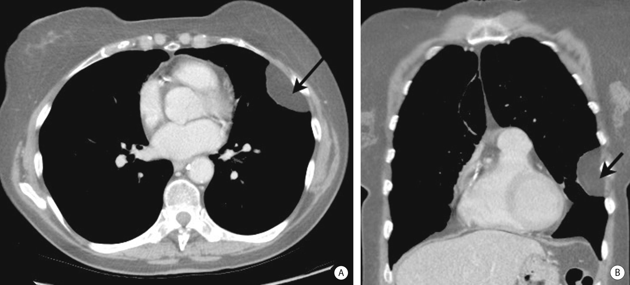 Axial (A) and coronal (B) CT images of a chest wall lipoma.