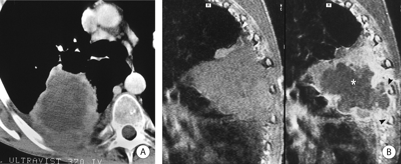 Invasive malignant T-cell lymphoma. (A) CECT. Enhancing peripheral tumour tissue is widely invading the posterior chest wall. (B) Sagittal T1WI (left) and T1WI + Gad (right) demonstrating the widespread invasion of the posterior chest wall by enhancing tumour tissue. There is invasion of 2 ribs, including cortical rib destruction (arrowheads). The central non-enhancement of the tumour is due to necrosis (asterisk). *