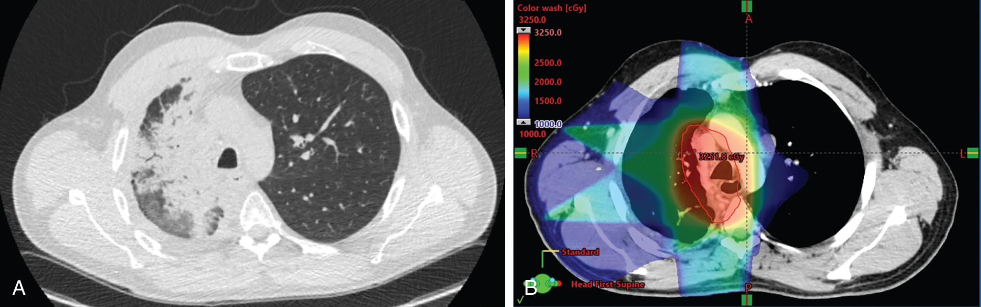 Fig. 31.1, Evidence of radiation pneumonitis on (A) CT chest in a 40-year-old male with a history of stage IV, T4N3M1, squamous cell carcinoma, programmed death-ligand 1 (PDL1) 50% of the right lung status-post carboplatin/taxol chemotherapy ×6 cycles and maintenance pembrolizumab ×1 cycle, noted to have progression of disease with thoracic lymphadenopathy, vascular encasement of the right main pulmonary artery, and mass effect on the right mainstem bronchus. He was started on ipilimumab/nivolumab, and 1 month later initiated palliative radiation therapy 30 Gy in 10 fractions to the right lung and mediastinum using image-guided radiation therapy. He continued to have progression of disease and received docetaxel/ramucirumab. First restaging scans, 3 months from completion of radiation therapy, demonstrated radiation pneumonitis. In comparison to the (B) external beam radiation plan, consolidation on CT coincides with the 50% isodose line. Planning target volume is outlined in red. Patient experienced a cough; no dyspnea, hemoptysis, or fever. He was started on corticosteroids with taper and clinically improved.