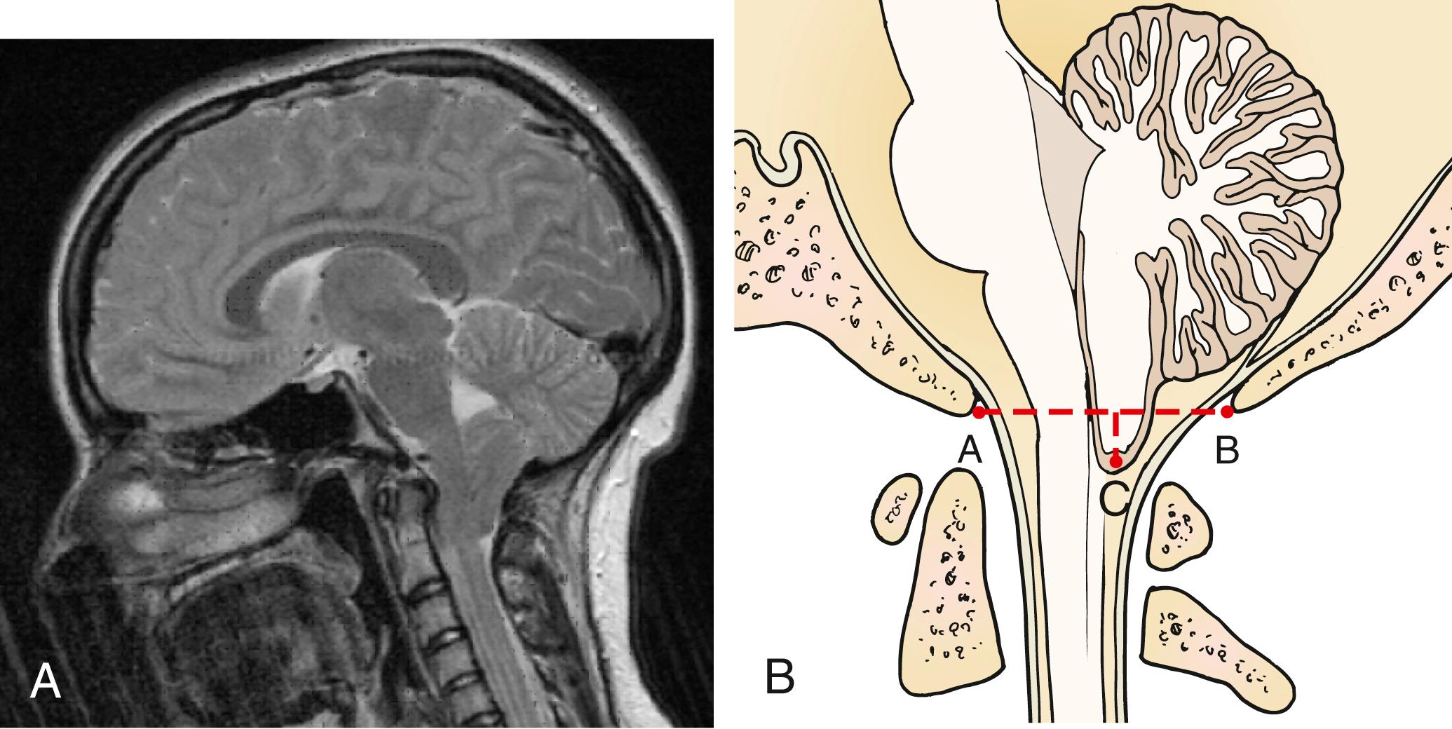 Fig. 28.1, A, Sagittal magnetic resonance imaging demonstrating typical Chiari I findings including 18-mm tonsillar descent. B, Schematic demonstrating the appropriate technique to measure the degree of tonsillar descent. The line from A to B represents the McRae line; a perpendicular line is then measured from this point to the inferior aspect of the cerebellar tonsil ( C ).