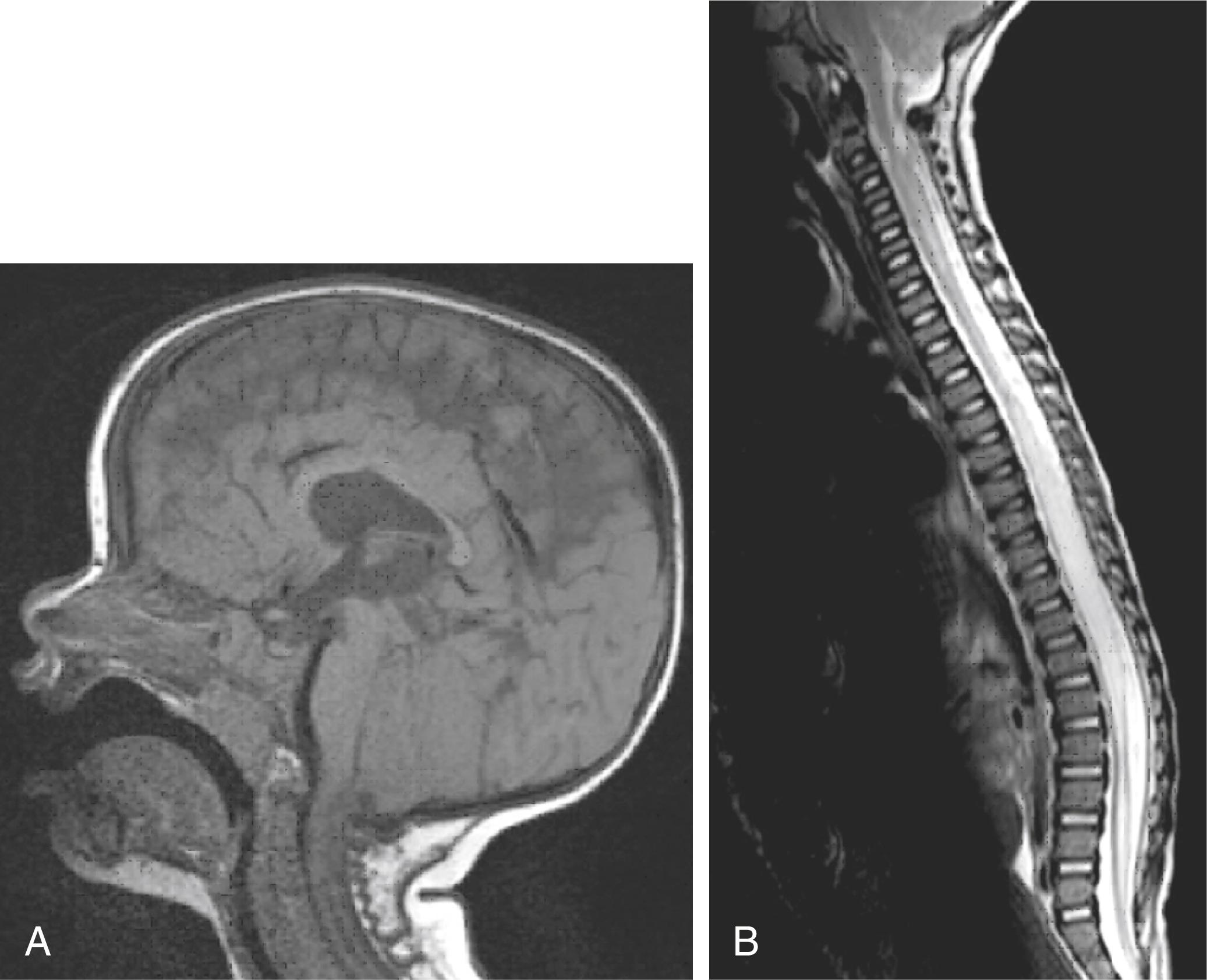 Fig. 28.2, A, T1-weighted sagittal magnetic resonance imaging (MRI) of an 18-month-old boy with Chiari II malformation, recurrent aspiration, and dysphagia, demonstrating typical features of Chiari II with elongated brain stem and cerebellar tonsils in the upper cervical region. B, T2-weighted sagittal spine MRI of the same patient demonstrating large spinal cord syrinx and low-lying cord secondary to myelomeningocele.