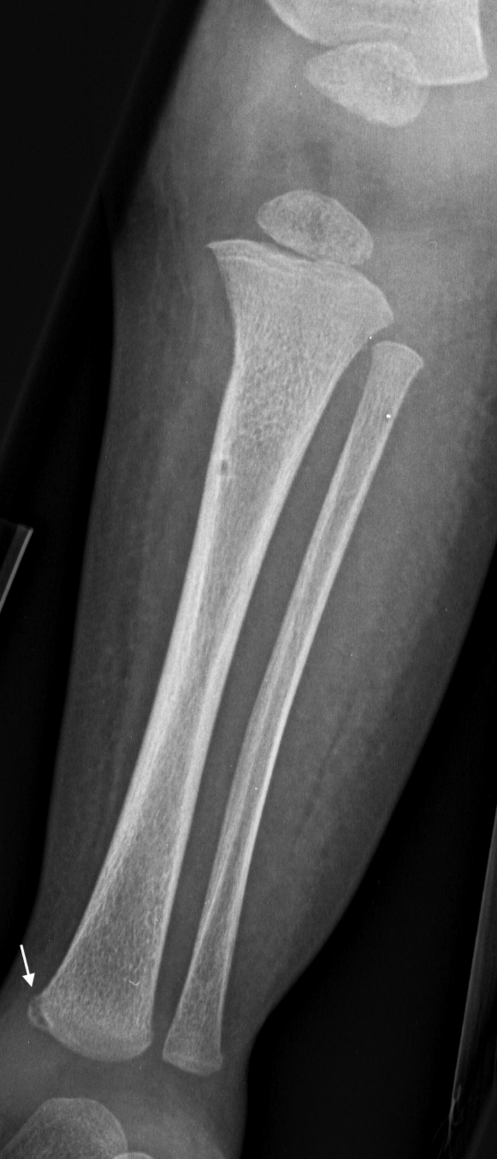 Fig. 21.1, AP radiograph of the tibia in a 5-month-old girl demonstrating a classic metaphyseal lesion along the medial aspect of the distal tibia ( arrow ).