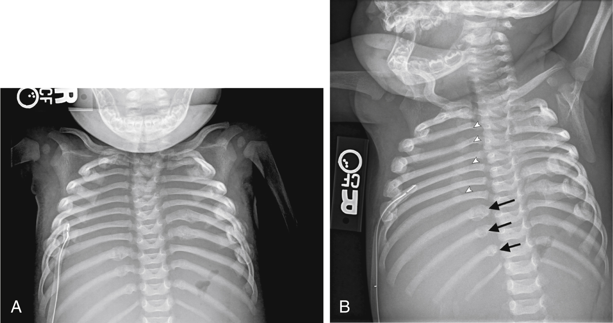 Fig. 21.2, Frontal view of the chest (A) in a 4-month-old girl demonstrates multiple lateral and posterior rib fractures. Postmortem oblique view of the ribs (B) demonstrates the appearance of sternal ossification centers ( arrowheads ), which can mimic callous formation from healing rib fractures ( arrows ) on oblique radiographs.