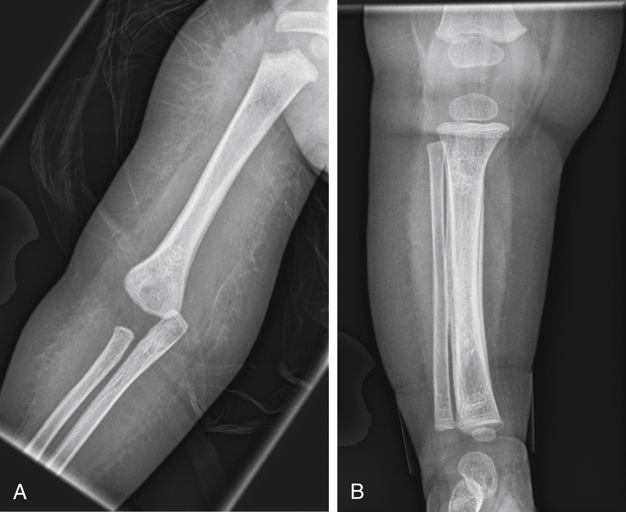 Fig. 21.3, Injuries of different ages in a 10-month-old.