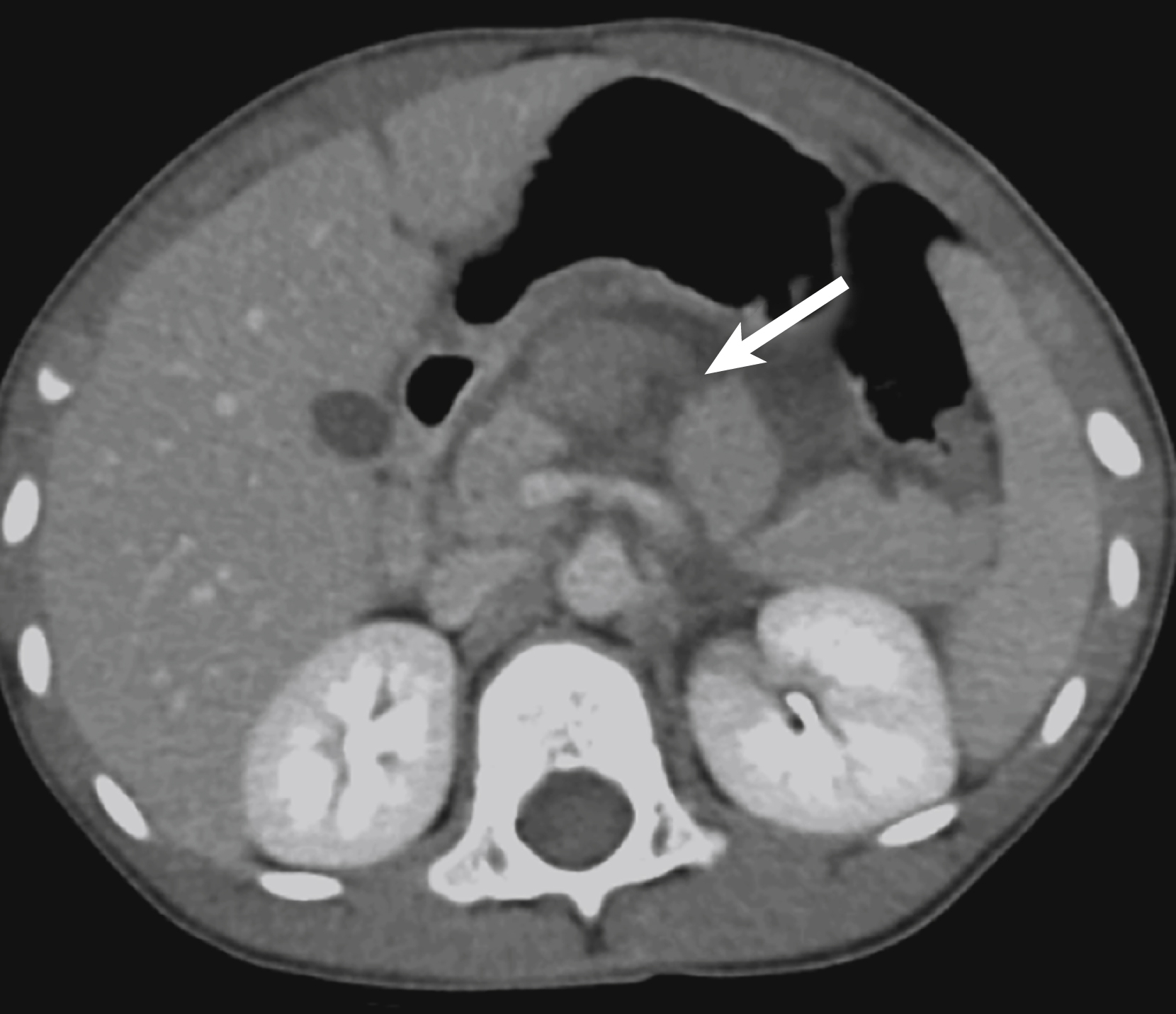 Fig. 21.5, A 4-year-old with abdominal pain and no reported history of trauma.