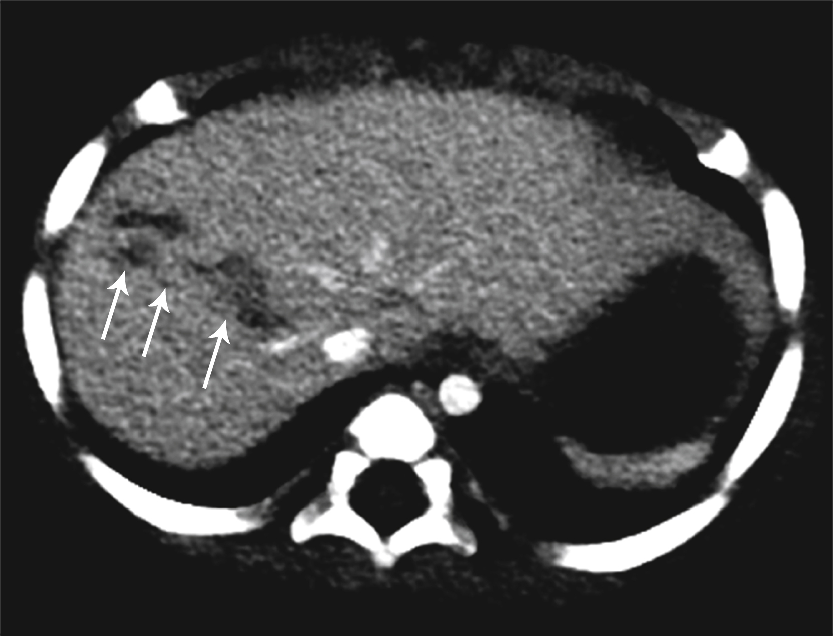Fig. 21.6, A 5-month-old with multiple fractures (not shown) and elevated liver enzymes. Although suspected abuse patients may have benign abdominal examinations, referring clinicians will often perform laboratory tests to determine whether they need to do abdominal imaging.