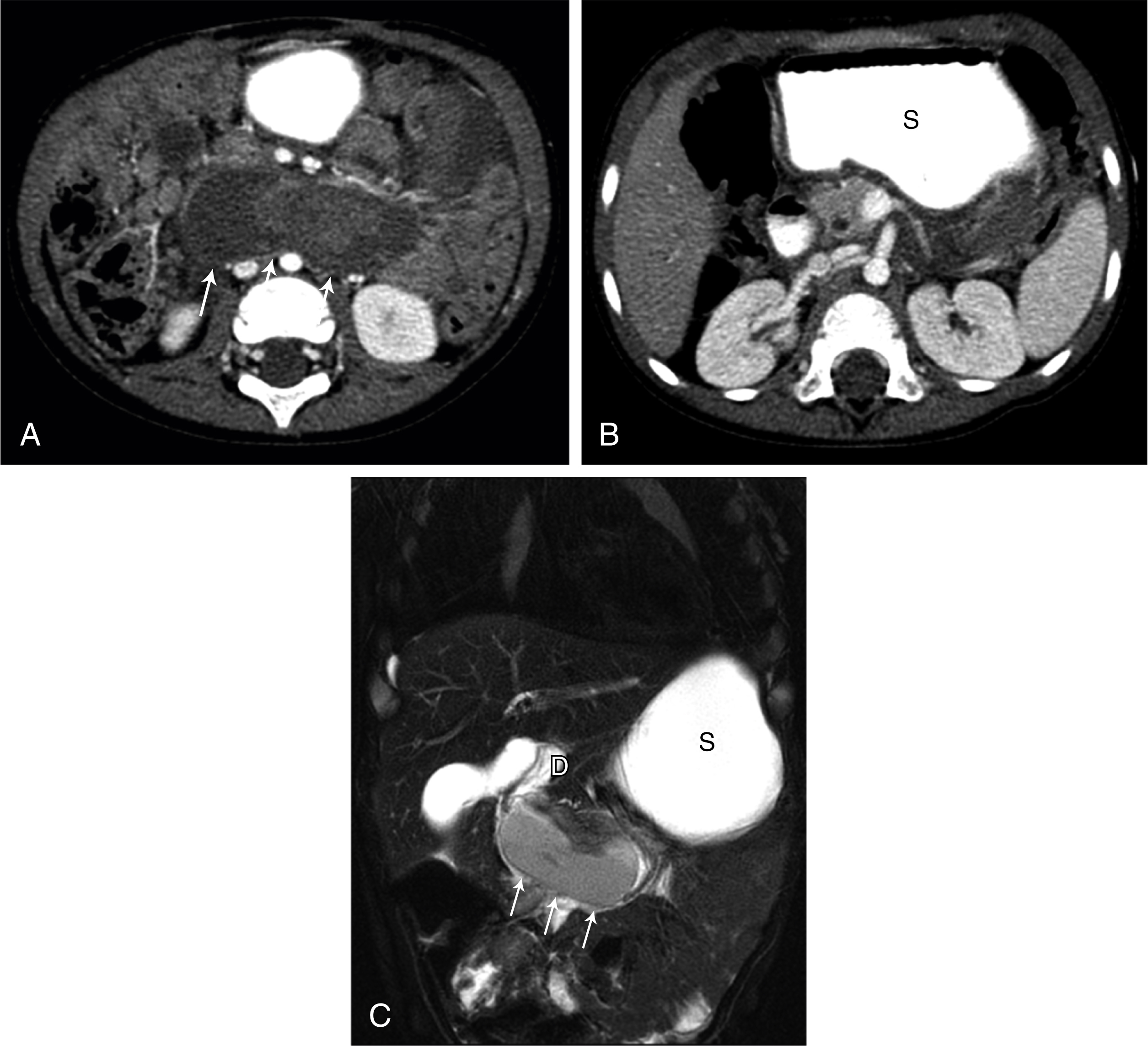 Fig. 21.7, Duodenal hematomas from abuse.