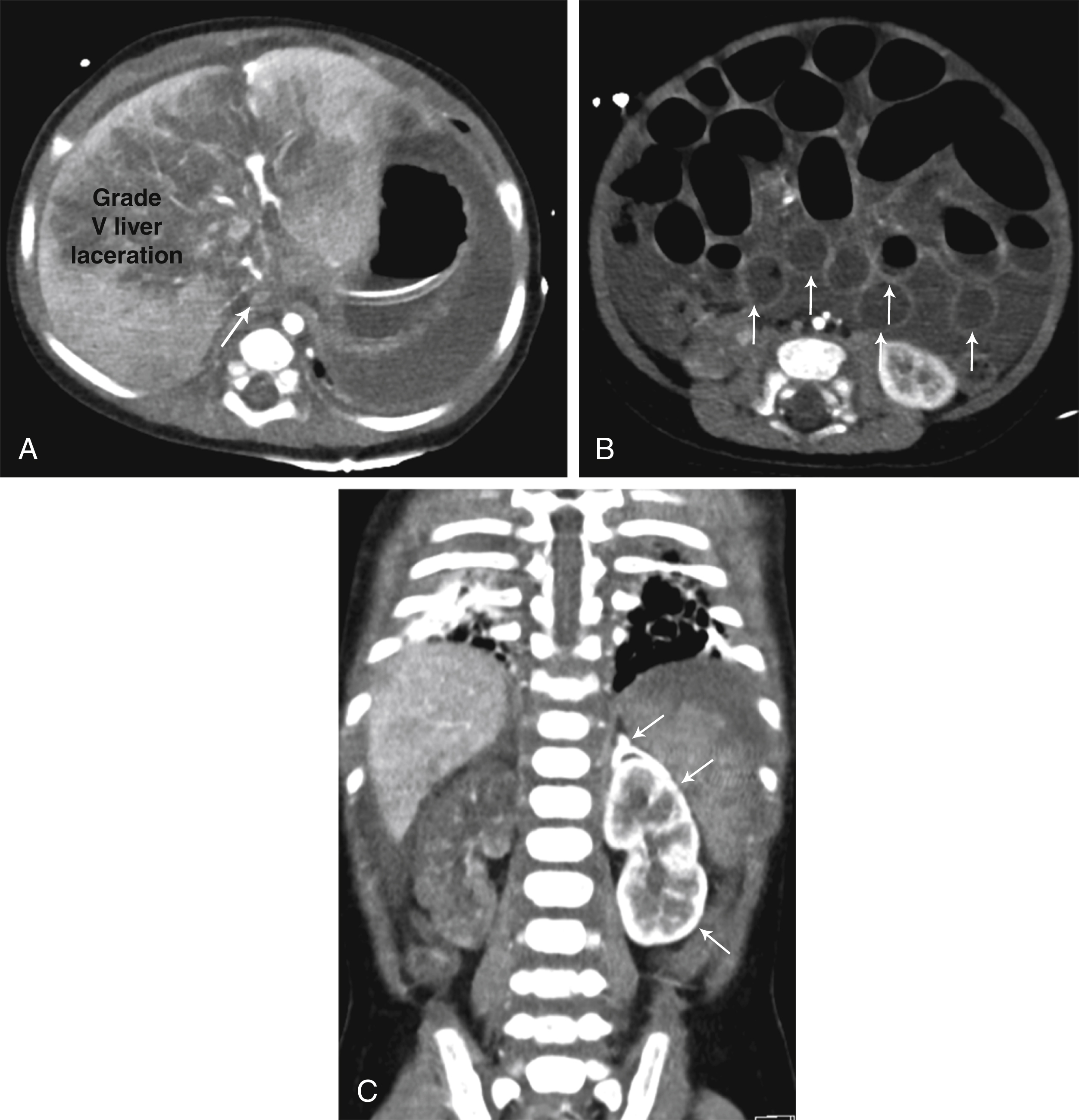 Fig. 21.8, Hypoperfusion complex, also known as shock syndrome.