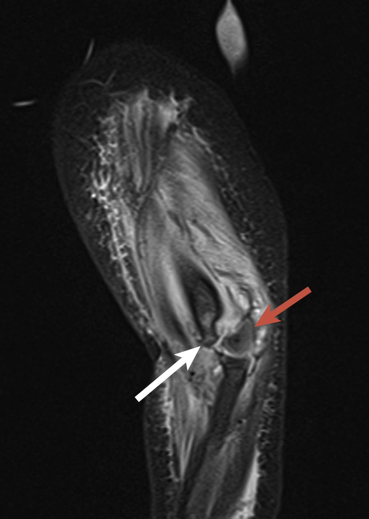 Fig. 21.9, Sagittal Short Tau Inversion Recovery (STIR) magnetic resonance image demonstrating physeal separation injury at the distal humerus in a 10-month-old boy. The nonossified capitellum ( red arrow ) is separated from the distal humeral metaphysis ( white arrow ) but remains aligned with the proximal radius.