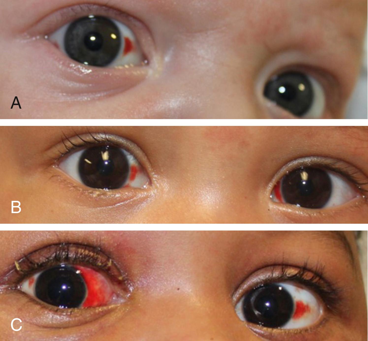 Fig. 6.1, Sentinel injuries. (A) This 4-month-old infant was noted to have subconjunctival hemorrhages on multiple occasions, which were initially attributed to straining with bowel movements. Fortunately, they were recognized as a sign of trauma and further evaluation revealed facial bruising, an upper frenulum tear and three healing posterior rib fractures. (B) This 7-month-old infant was noted by her parent to have recurrent subconjunctival hemorrhages and facial petechiae. Her medical evaluation revealed facial bruising, an upper frenulum tear, a posterior rib fracture, and positive drug screen. (C) This 5-month-old infant presented to a children’s hospital after an assault by his father. Child was found to have a skull fracture, significant facial and chest bruising, as well as a tibial fracture.