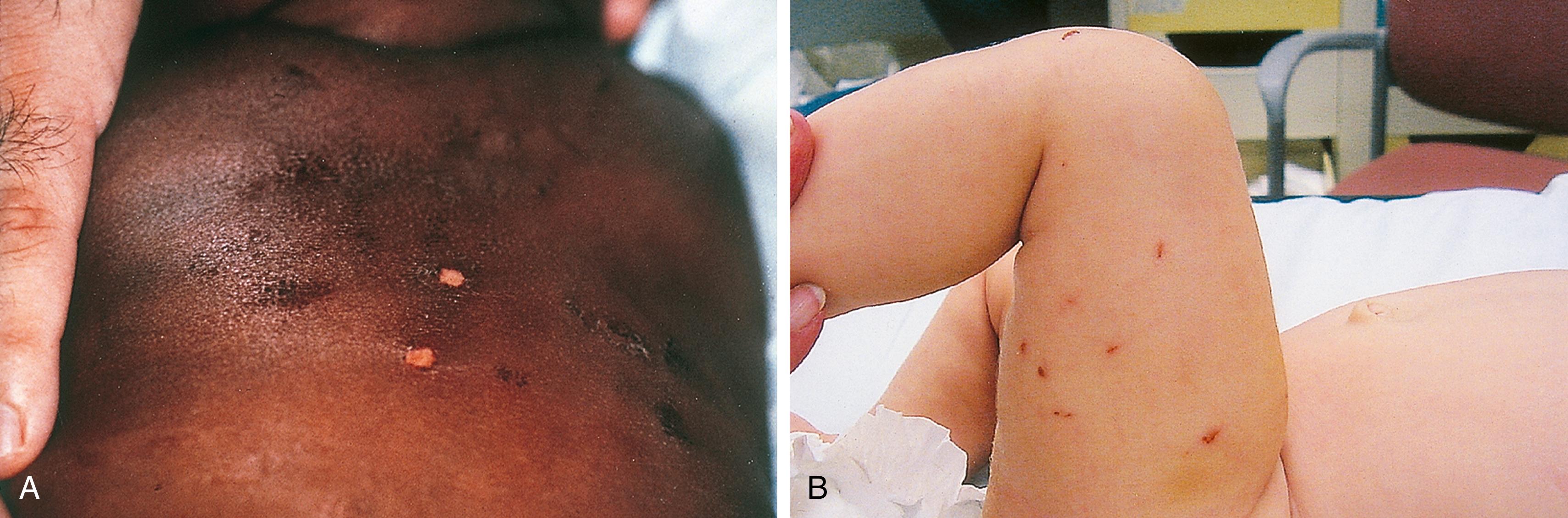 Fig. 6.11, (A) Inflicted abrasions/lacerations. A pattern of parallel abrasions that overlie ribs and vertebral bodies is seen on the back of this infant who was dragged over a carpet. The lesions are at least 1 to a few days old, and surface scabs have separated from two areas. A displaced spiral fracture of the right humerus, with marked soft tissue swelling and pain on motion, was also detected. (B) This 1 year old had numerous small linear and arc-shaped abrasions and superficial lacerations over both legs, consistent with fingernail marks. She also had many other bruises, an occipital skull fracture, a posterior interhemispheric subdural hematoma, multiple metaphyseal chip fractures, and an abscessed nasal septal hematoma.