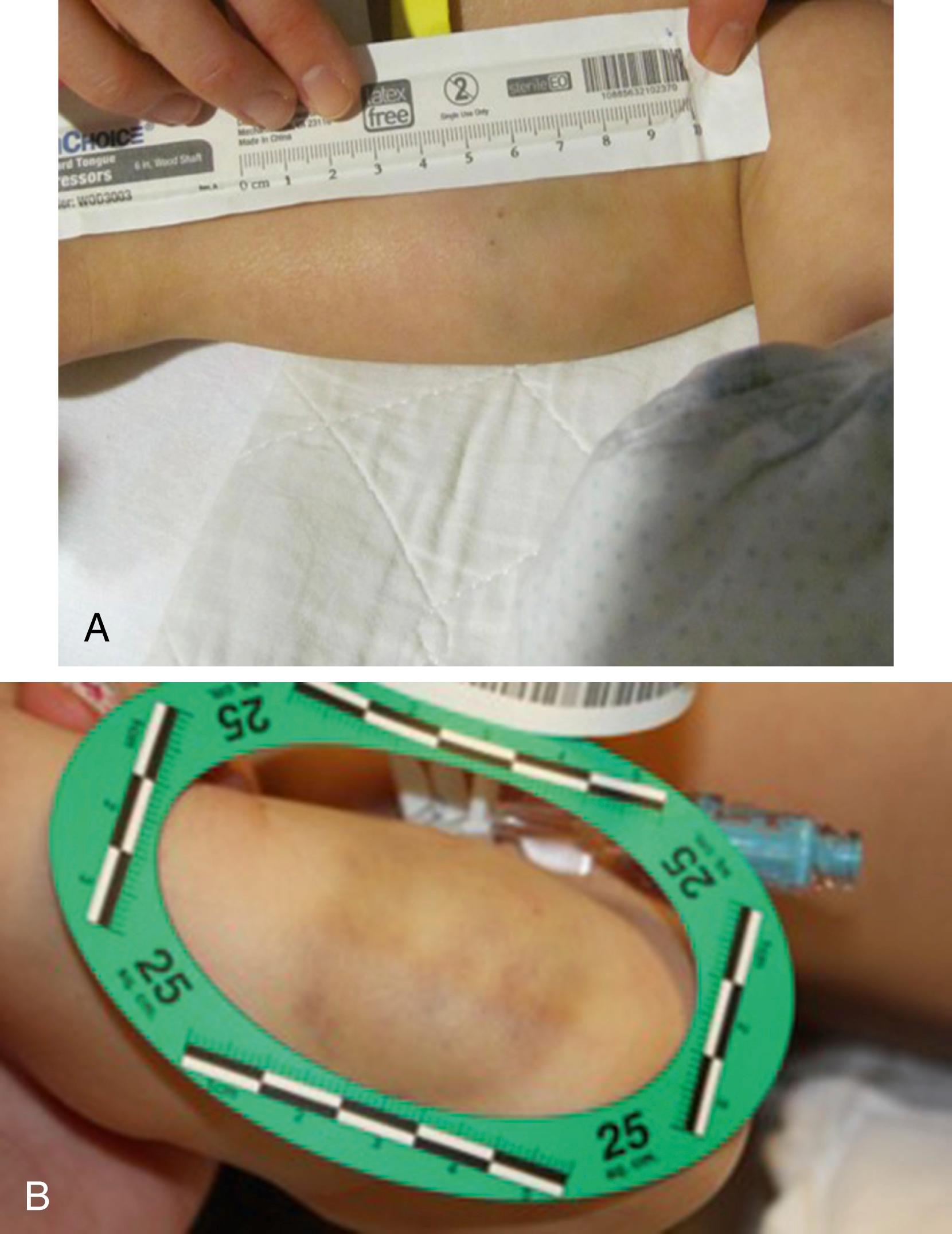 Fig. 6.13, (A) 23-month-old with abusive head trauma, malnourishment, and multiple cutaneous injuries, including this bite injury on her calf. Another child in the home disclosed seeing an adult bite this child. (B) 14 m/o with a history of a spiral humerus fracture at 2 months of age presented with abusive head trauma and bruises on many surfaces, including this bite injury on her forearm.