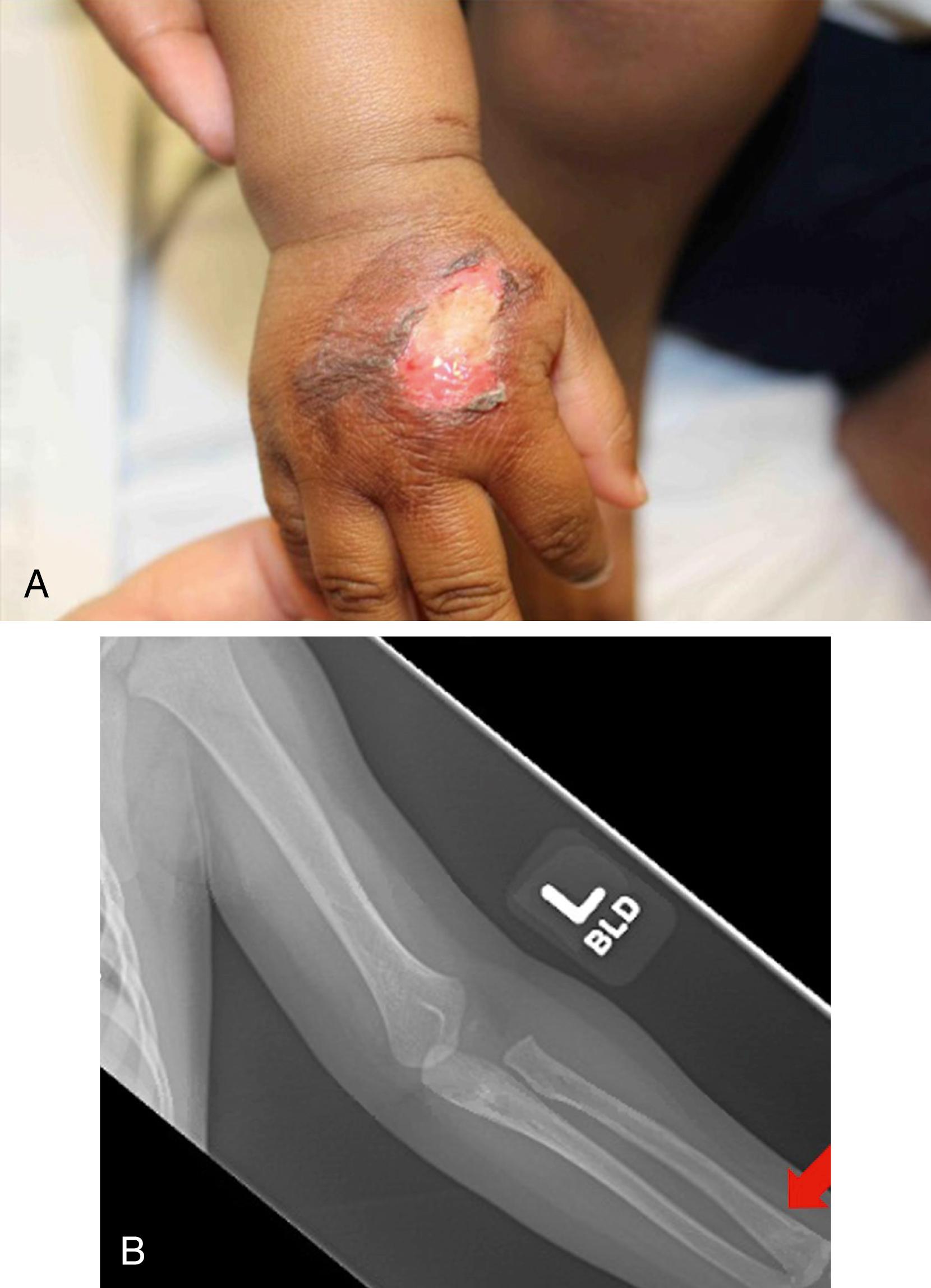 Fig. 6.14, (A) 13-month-old infant brought for medical attention 2 days after sustaining a burn to the dorsal aspect of her hand after a caregiver put her hand under running water. Due to the delay in medical attention, the mechanism provided, and child’s age, a skeletal survey was performed that revealed a healing transverse fracture of the left radius (B). This untreated and unexplained fracture, together with the child’s burn, raised significant concern for child’s safety.