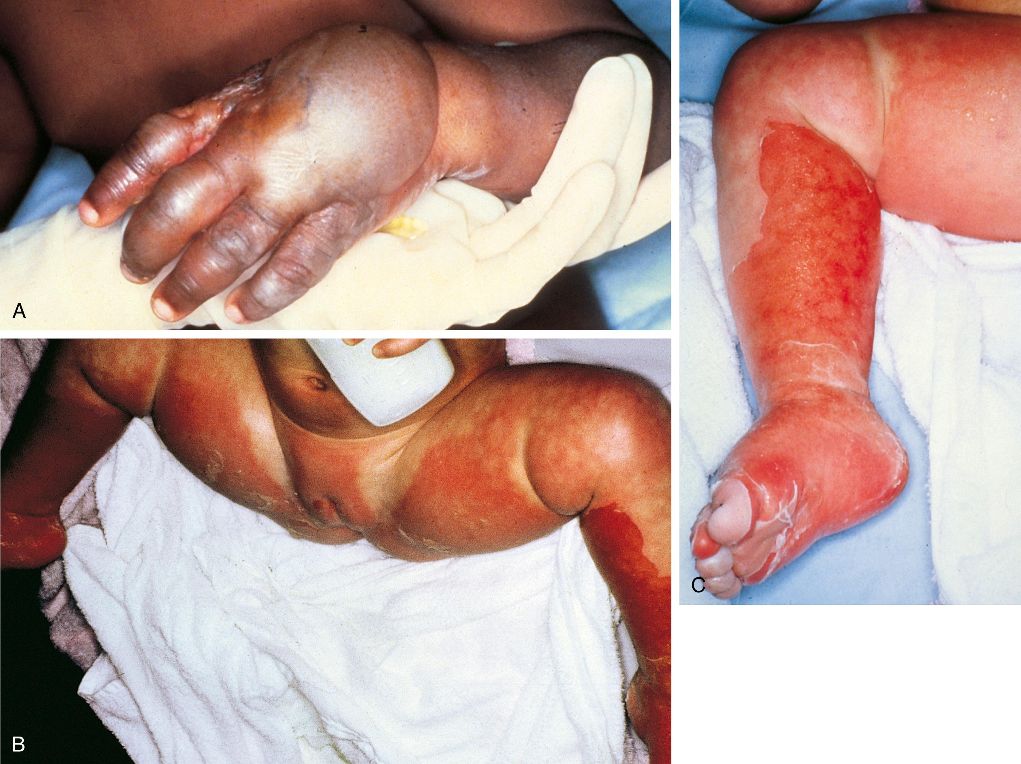 Fig. 6.15, Inflicted scalds. (A) After getting his hands into something he was not allowed to touch and making a mess, this child’s hands were held down in hot water, resulting in severe second-degree dip burns. Note the sharp line of demarcation just above the wrist joint and the uniform depth of the burn. (B) This toddler was dipped in a tub of scalding water while being held under the arms and knees, as a “lesson” after a toileting accident. (C) Close-up of severe second-degree burns of the foot and lower leg of the same child.