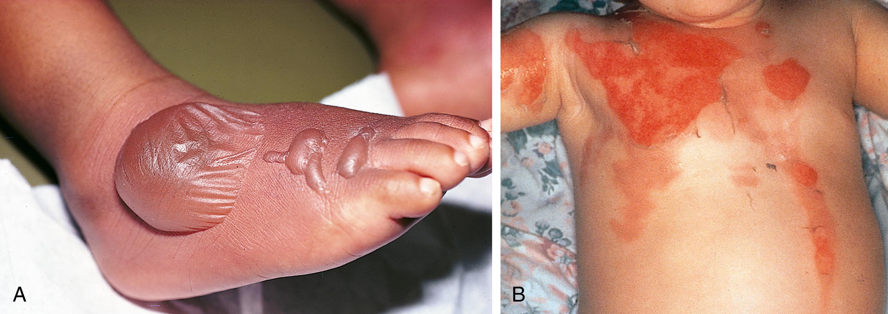 Fig. 6.16, Accidental scalds. (A) The splash-and-droplet pattern of an accidental scald is evident on the foot of a toddler who grabbed a hot cup of tea from the table while sitting on his grandmother’s lap. (B) This toddler grabbed a pot handle projecting out over the edge of a stove, spilling hot soup over her chest and shoulder. Cooling of the hot liquid as it flowed downward produced the inverted arrowhead pattern, the burn being wider and of greater depth proximally and narrowing and becoming more superficial distally. There is also a descending droplet and splash pattern to the left of the midline.