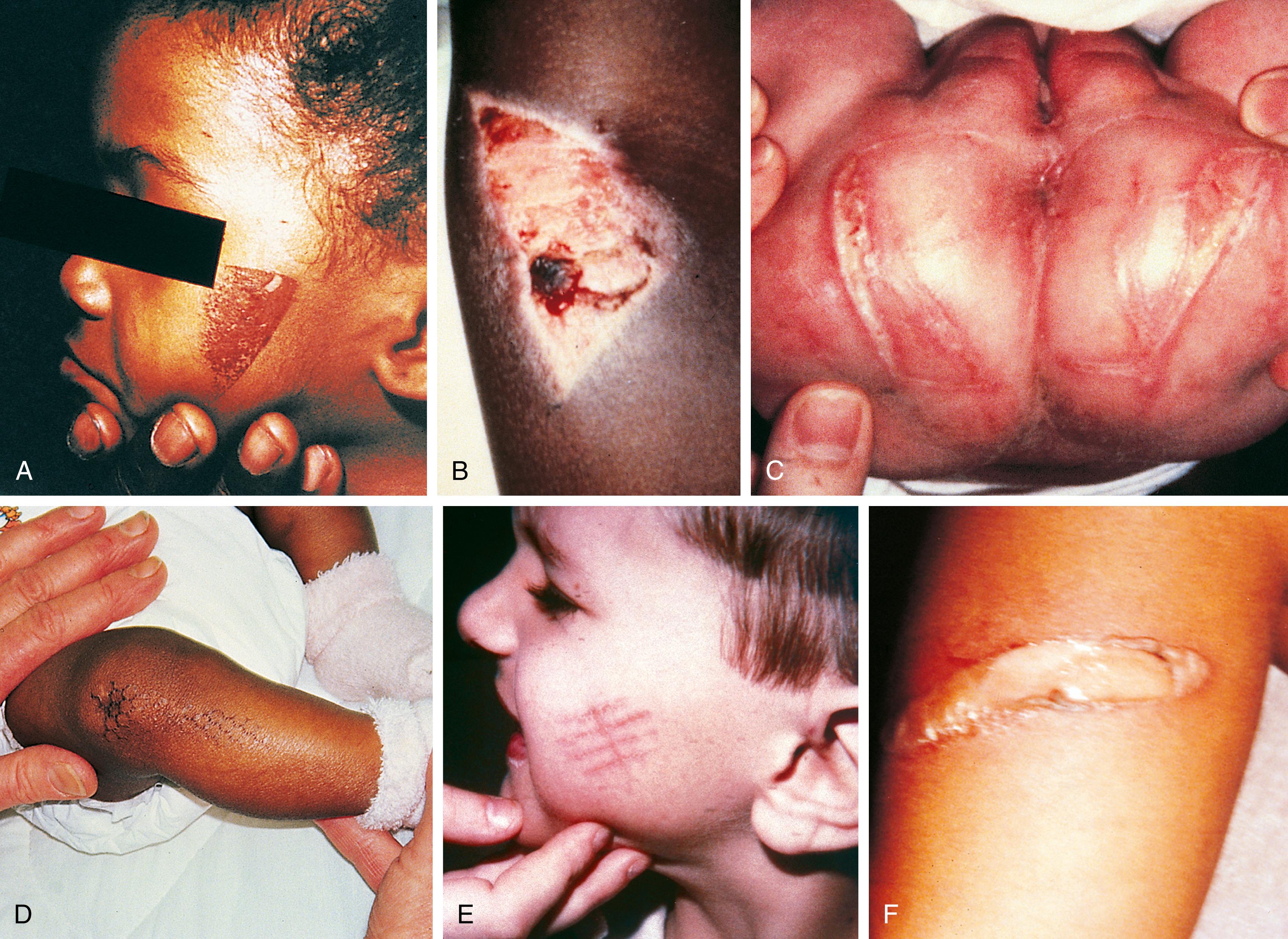 Fig. 6.17, Contact burns or branding injuries. (A) This child, who was acting out while his mother ironed, was punished when she held the tip of the iron against his cheek. (B) A healing full-thickness burn in the shape of an iron was found when this boy’s shirt was removed prior to his being given vaccine injections. He had been sent home after his first day in kindergarten with instructions not to return until he was caught up on his immunizations. (C) These linear full-thickness burns were incurred when this 6-week-old infant was forced to sit on the hot grill of a space heater. The history given was that she had crawled over to the space heater, knocked it over, and then sat on it. (D) Another infant presented with a history of irritability and a rash. The “rash” has a honeycomb configuration that matched that of a radiator cover in her home. She also had multiple fractures. (E) These facial burns are the result of being branded with the grill of a hair dryer. The boy had been acting out while he was supposed to be getting ready for school and his mother was drying her hair. (F) The hot wand of a curling iron leaves a cigar-shaped, partial- to full-thickness burn.