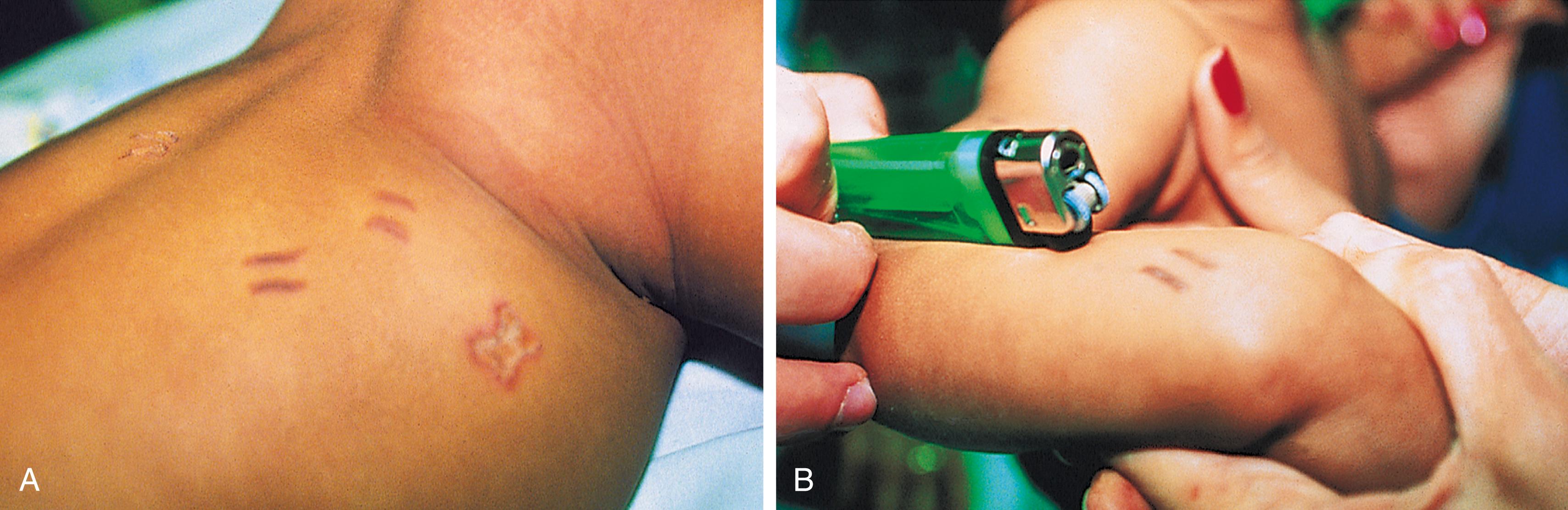 Fig. 6.19, Cigarette lighter burns. (A) Two pairs of lesions with the appearance of parallel serrated lines and a deep burn in the shape of a butterfly were found on examining this infant, who was brought to the emergency department for treatment of a rash. (B) Astute deduction by a resident and social worker led to the discovery that heated cigarette lighter wheels had been used to inflict the burns. The full-thickness butterfly is the result of repeated application.