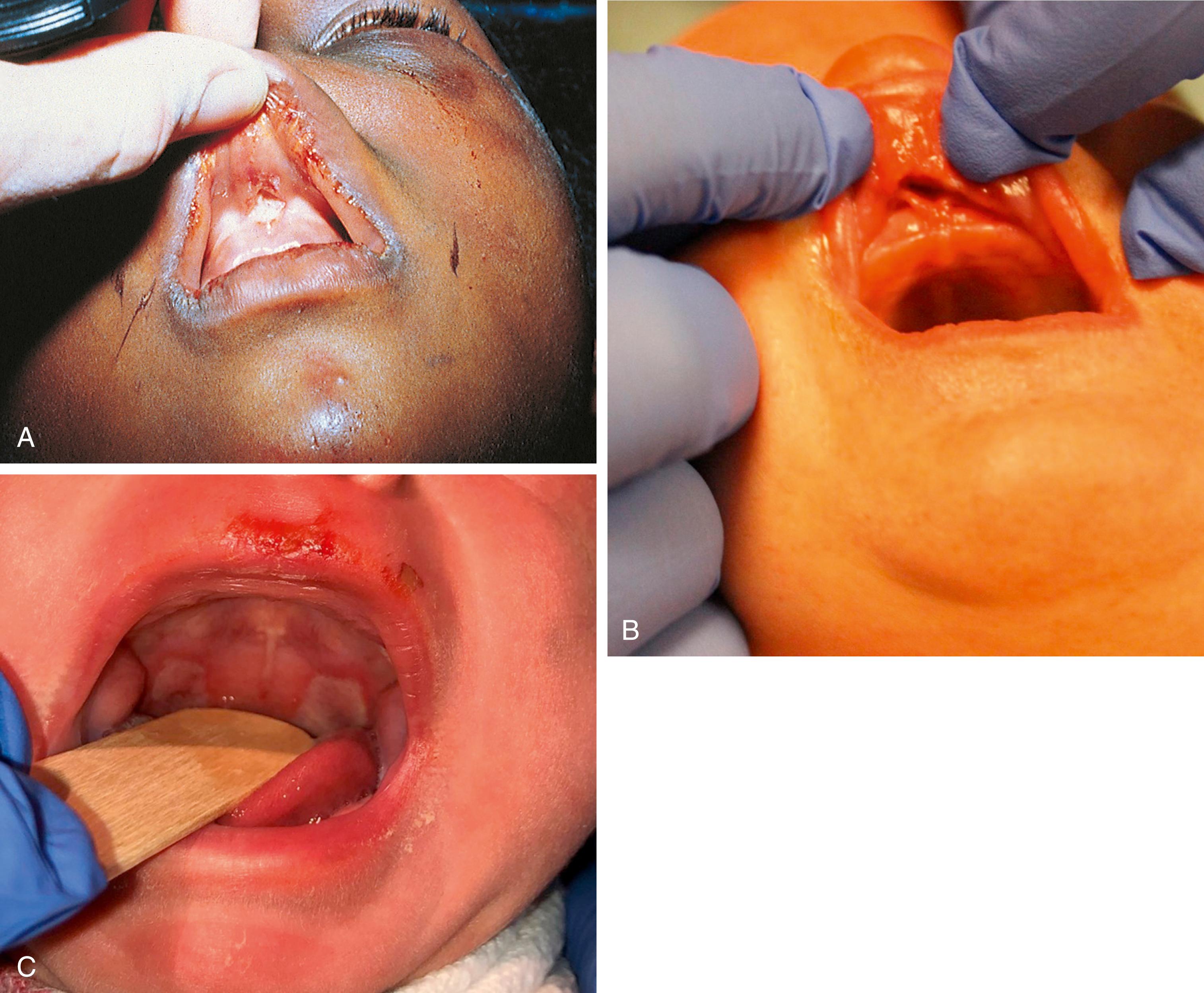 Fig. 6.20, (A) Frenulum tear. This badly beaten boy incurred a torn frenulum when his abuser tried to muffle his cries by forcibly holding his hand over the child’s mouth. Note the facial bruises. (B) Child presented with blood from the mouth without a history of trauma. Found to have an upper frenulum tear, facial bruising, multiple classic metaphyseal lesion (CML) fractures, and healing posterior rib fractures. (C) 6-week-old baby admitted with failure to thrive, found to have an upper frenulum tear, lip abrasions, injuries to his soft palate bilaterally, facial bruising, and his drug screen was positive for cocaine. On follow up x-rays, child found to have four healing posterior rib fractures. Additionally, child had gained weight well in a safe environment.