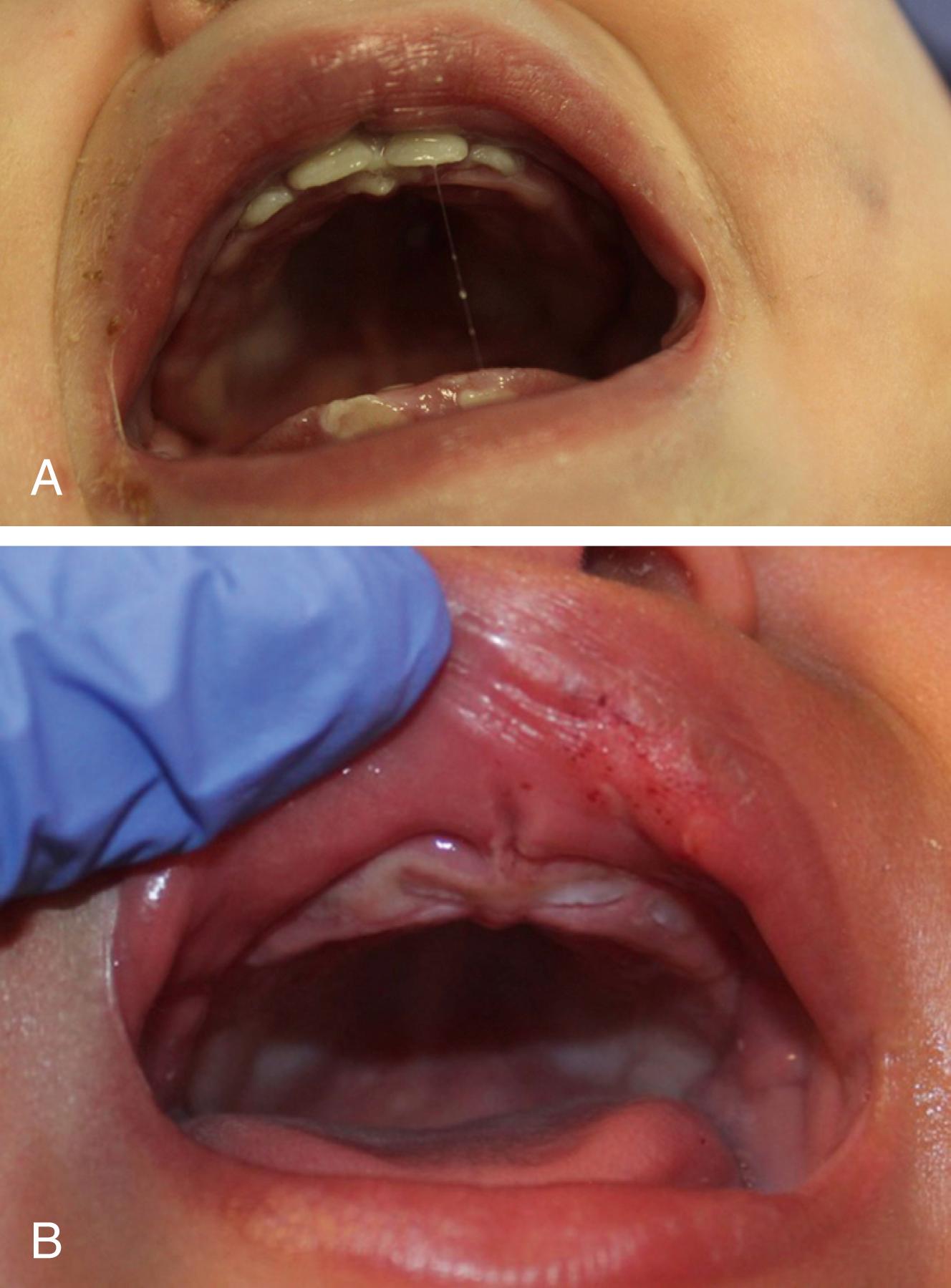 Fig. 6.2, (A) This 11-month-old infant had a history of “easy bruising” and was evaluated by hematology. When she ultimately presented to a hospital, she was found to have acute subdural hemorrhages, multiple skull fractures, bruising over most surfaces of her body, and more than 20 fractures. Also found on exam was extensive granulation tissue on her frenulum, gums, tongue, and palate. (B) This 7-month-old, non-ambulatory infant was noted to have bleeding from her mouth that was attributed to teething. A thorough examination and evaluation revealed an upper frenulum injury, two healing posterior rib fractures, an acute humerus fracture, and a grade 3 liver laceration.