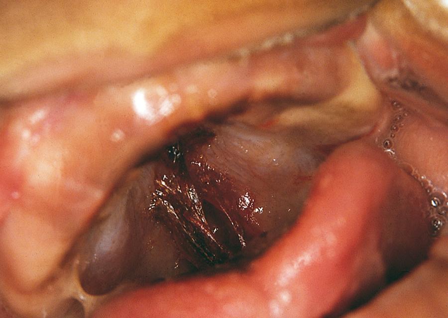 Fig. 6.21, Inflicted palatal lacerations. This infant’s soft palate was shredded by repeated stabs with a sharp object. He presented with a complaint of spitting up blood and no history of trauma.