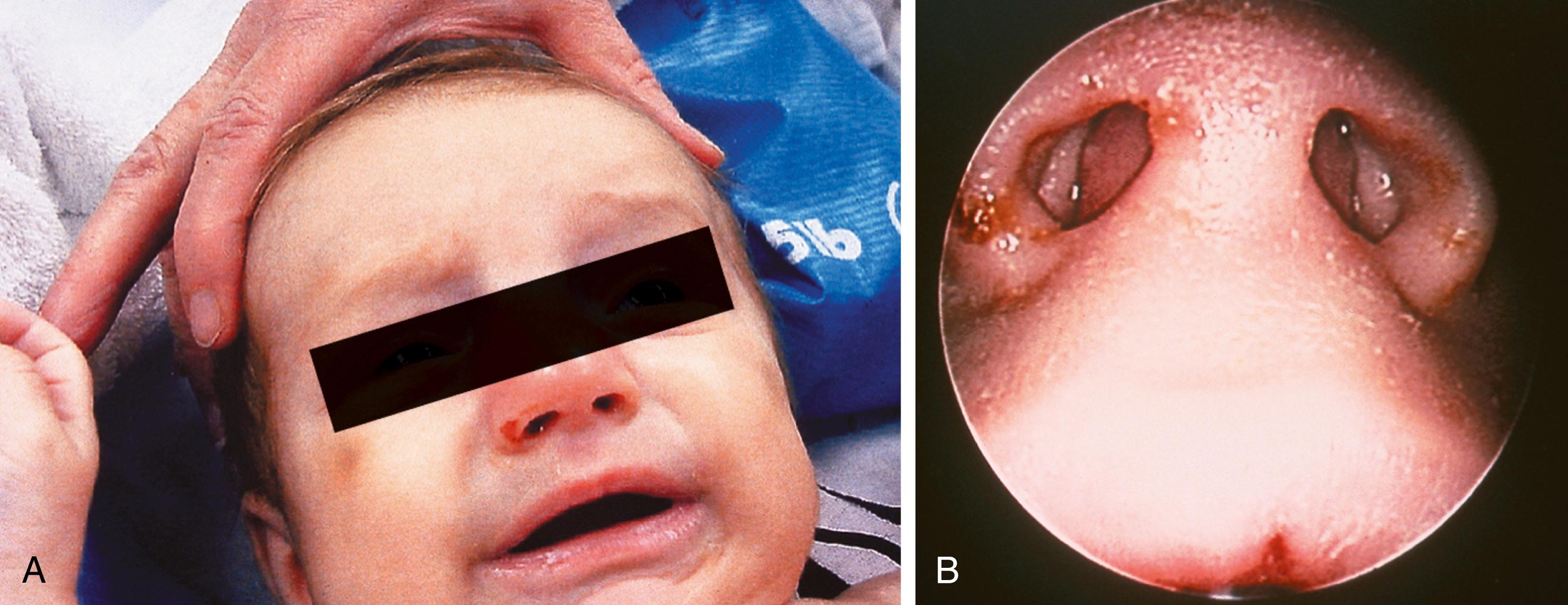 Fig. 6.22, Abscessed nasal septal hematoma. This 3-month-old baby brought to the emergency department with complaints of fever and difficulty breathing was found to have a red swollen nose (A) and erythematous bulging of the nasal septum bilaterally (B), obstructing her nasal passages. Note the small central lip laceration. She also had multiple bruises, fingernail, an occipital skull fracture, a subdural hematoma, and multiple metaphyseal chip fractures.