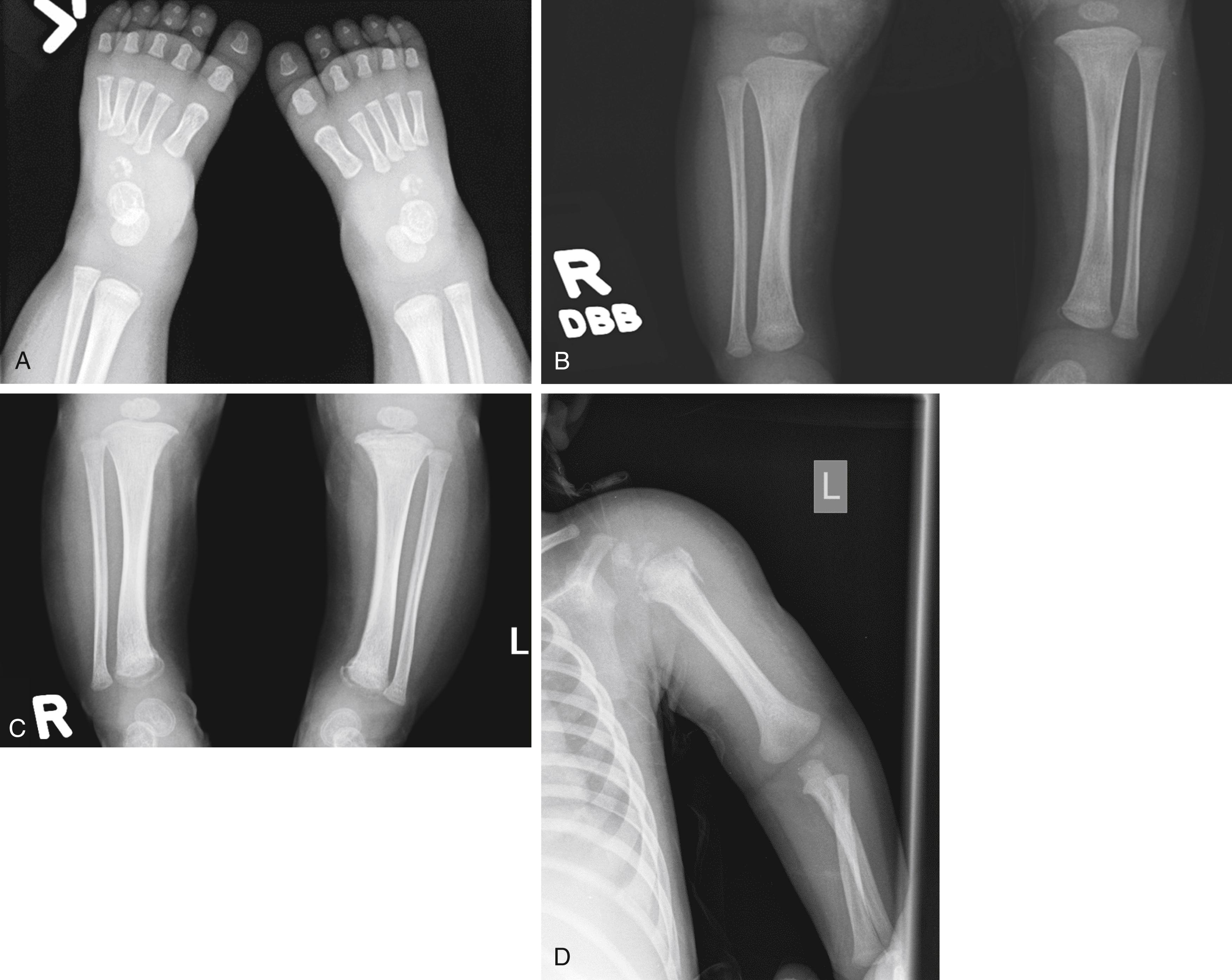 Fig. 6.23, (A) 6-week-old baby admitted with failure to thrive, found to have an upper frenulum tear, lip abrasions, injuries to his soft palate bilaterally, facial bruising, and his drug screen was positive for cocaine. On follow up x-rays, child found to have four healing posterior rib fractures. Additionally, child had gained weight well in a safe environment. (B) 7-week-old sibling of a 3 y/o victim of physical abuse. A skeletal survey revealed bilateral distal tibia bucket handle (classic metaphyseal lesion [CML]/corner) fractures. (C) X-rays 2 weeks later showed healing bilateral distal tibia bucket handle (CML/corner) fractures. (D) 6-month-old infant presented to care due to decreased use of left arm without any history of trauma. Child found to have a left proximal humerus CML, a torn frenulum, and buttock bruising.