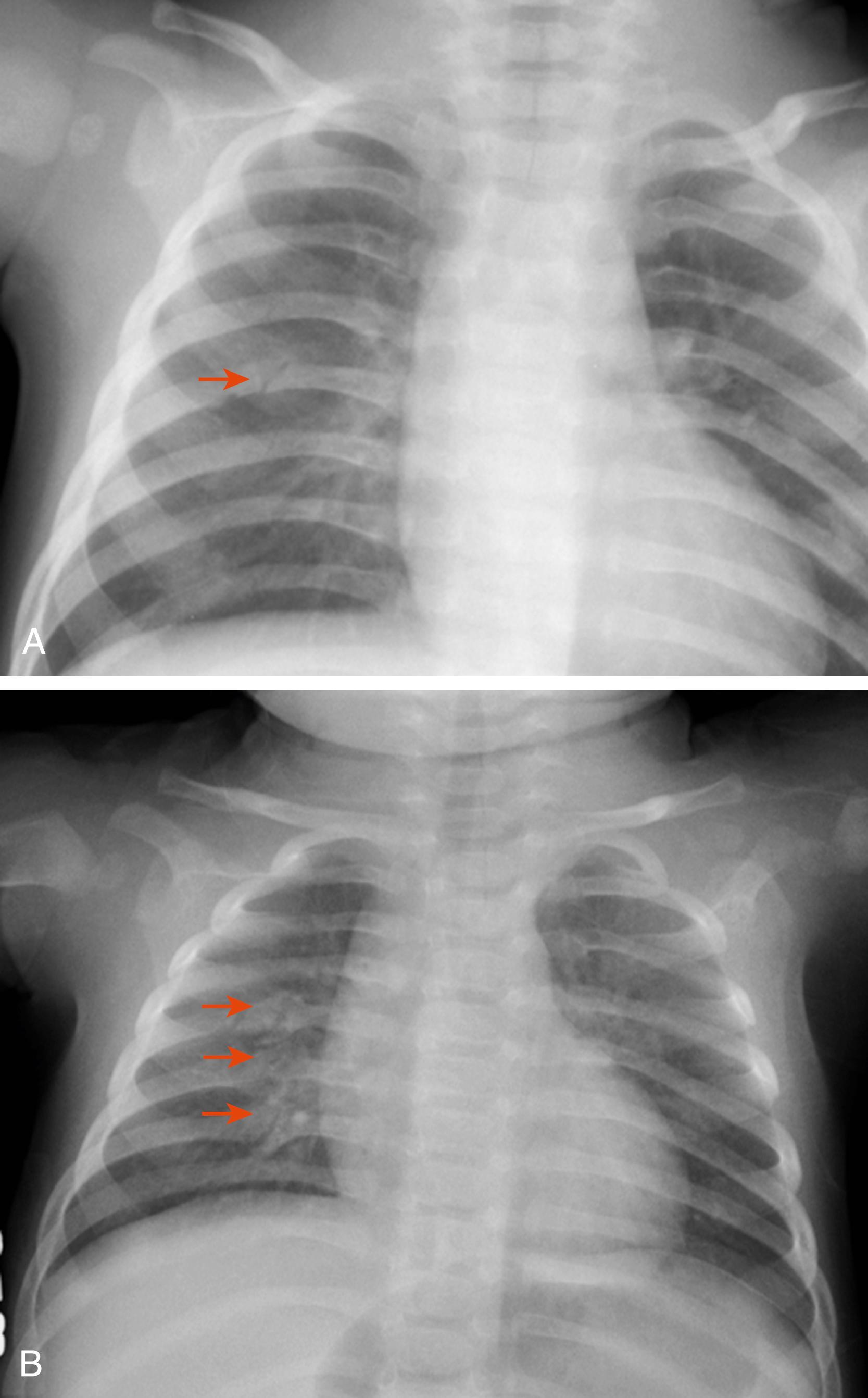 Fig. 6.24, (A) 4-week-old presented due to difficulty breathing in the setting of a fever. His sepsis evaluation included a chest x-ray, but this acute rib fracture was not discovered (see red arrow ). (B) Child returned for care 2 weeks later after an apneic spell and was found to have abusive head trauma, three healing rib fractures (see red arrows ), and bruising.