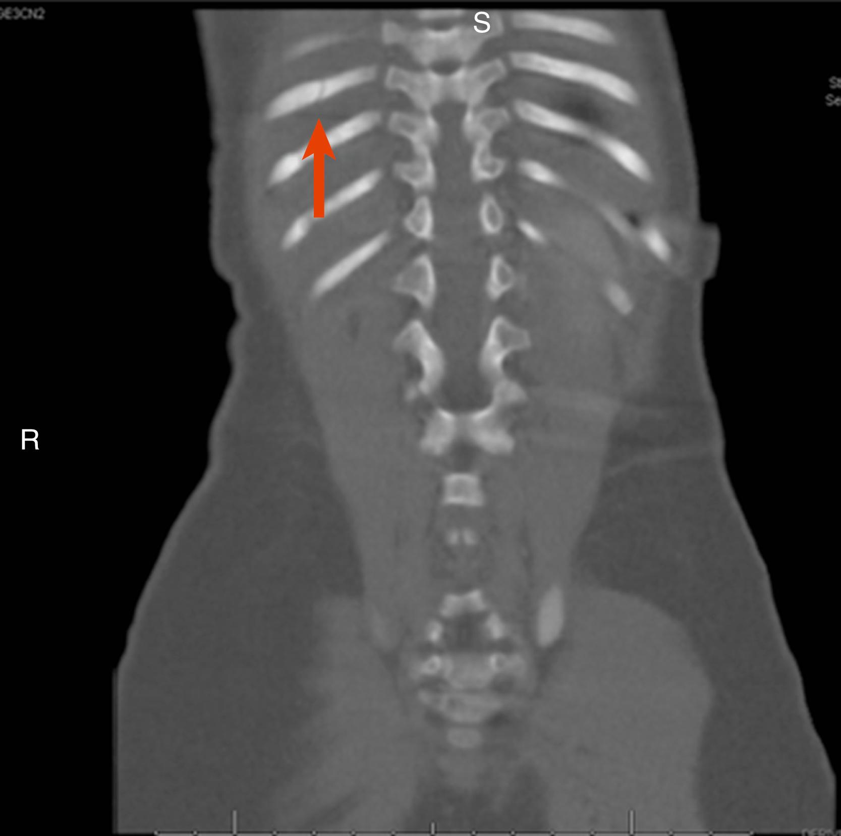 Fig. 6.25, 8-month-old infant with an unexplained parietal skull fracture was noted to have elevated liver function tests (LFTs), which prompted an abdominal CT that revealed this acute 9th posterior rib fracture (see red arrow ).