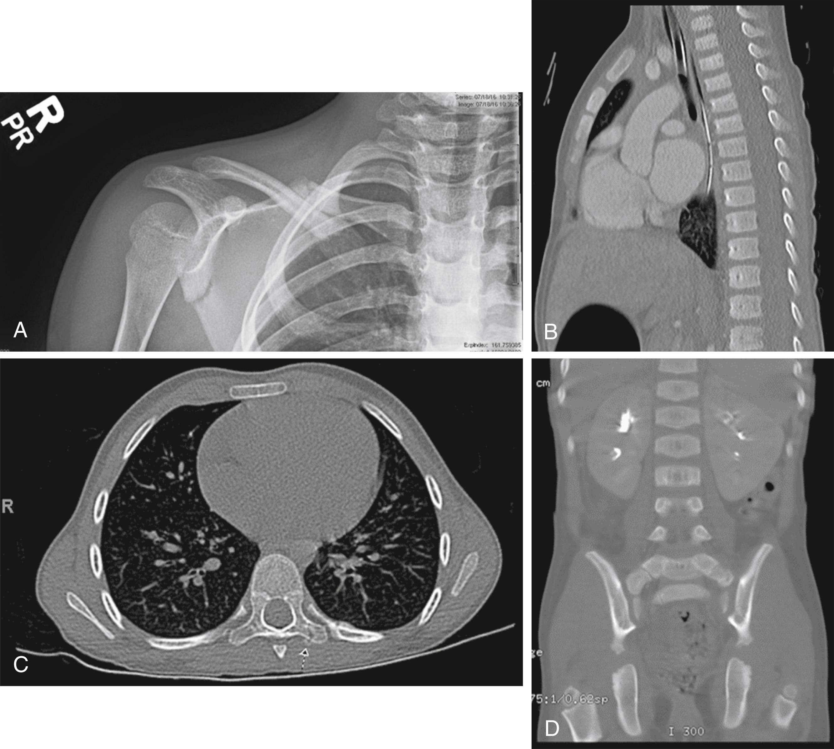 Fig. 6.26, (A) 4 y/o F in foster care who disclosed an adult pulling her arm back until she “heard a crack and I thought my arm was going to fall off.” Child found to have a right clavicle fracture, a scapular body fracture. (B) In addition to subdural hemorrhages, skull fractures, and extensive bruising, this badly battered 2 y/o was found to have healing vertebral fractures of T2–T5. (C) 4 y/o child complained of back pain and disclosed to have been kicked in the back by an adult. Externally, she had a small bruise on her left back. An evaluation several weeks later revealed a left 8th posterior rib fracture and T8 transverse process fracture. (D) 5 y/o presented to an ED due to vomiting and refusal to bear weight. The discovery of extensive bruising prompted a trauma evaluation in which child was found to have elevated LFTs, pancreatic and hepatic lacerations, as well as fractures of the left sacral ala and right pubic ramus and 3 right sided rib fractures and 1 left rib fracture. Child’s 2 y/o sibling was evaluated due to physical abuse of the index child. He was noted to have multiple, healed nonspecific cutaneous injuries and was quite active in the exam room. His skeletal survey surprisingly showed healing fractures to three ribs, his fibula, and his right ischiopubic bone fracture. The history that child had never been symptomatic from his injuries was not plausible.