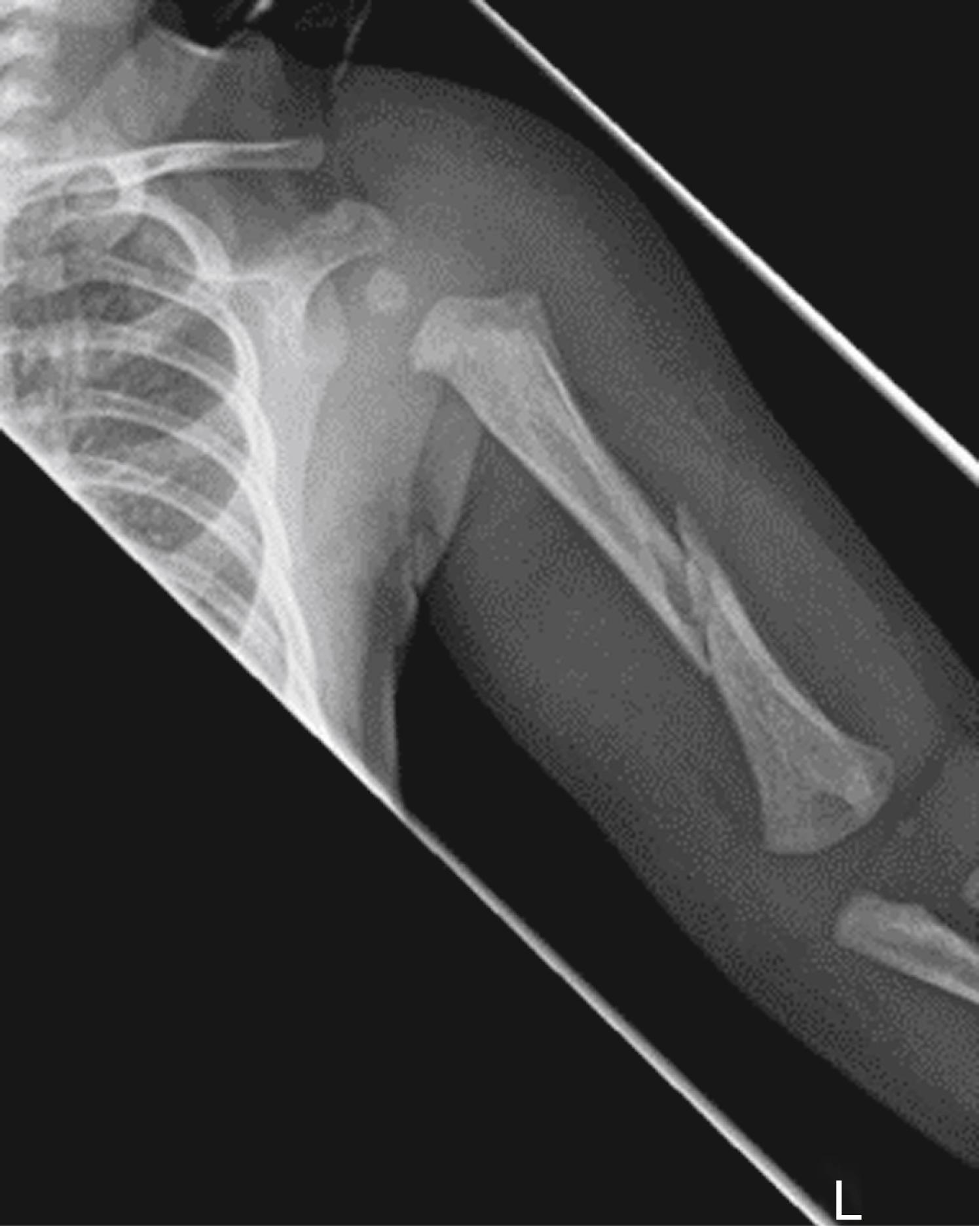 Fig. 6.27, 7-week-old infant presented due to a decrease in the use of her left arm. Child found to have more than 15 fractures. During pregnancy, her parents planned to put her up for adoption but reconsidered at birth.