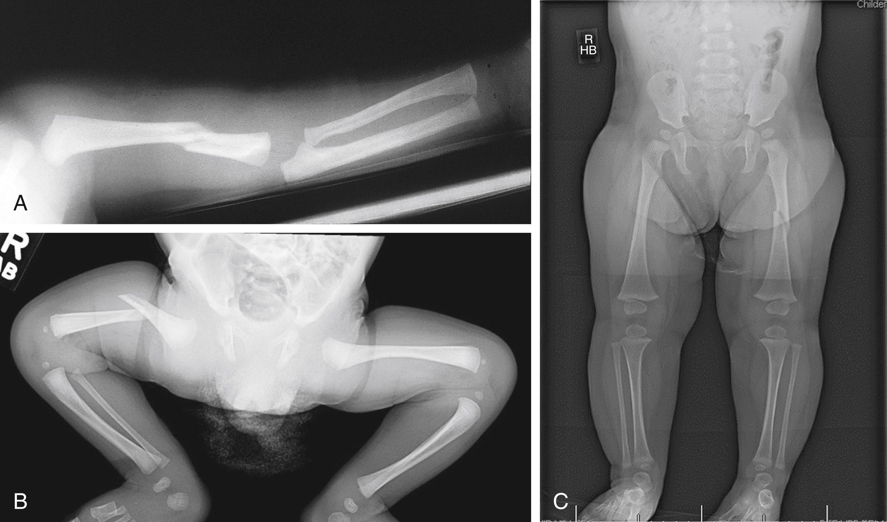 Fig. 6.28, (A) This partially displaced oblique fracture of the left humerus has faint evidence of early callus formation. The persistence of soft tissue swelling may be due to lack of proper immobilization and/or reinjury. (B) 2-week-old infant presented to medical care after being found to have right leg swelling with no history of trauma. Child also found to have back and leg bruising. (C) 19 m/o infant brought to care after caregiver heard a “pop” when removing her from a car seat. Child also had a history of an unexplained humerus fracture at 8 months of age and was diagnosed as being physically abused on multiple occasions.