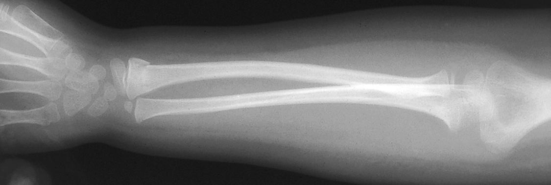 Fig. 6.29, Torus or buckle fracture. This 5-year-old girl with mild cerebral palsy presented with a history of unresponsiveness lasting more than an hour, following a possible seizure, and was found to have a hyperacute subdural hematoma. Subsequent skeletal survey found a previously unrecognized and clinically silent torus fracture of the left distal radius.