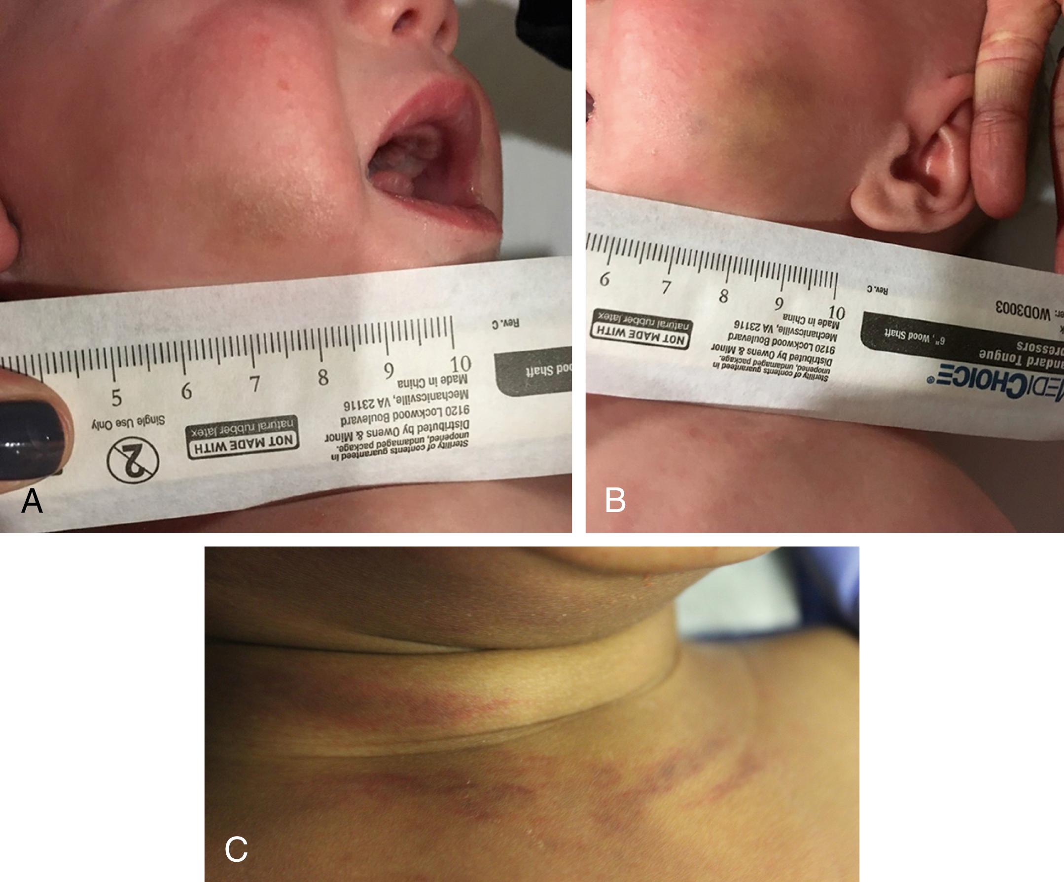 Fig. 6.3, (A) This 8-week-old infant was seen in an emergency department (ED) for respiratory distress, initially attributed to bronchiolitis. The discovery of bilateral cheek bruising prompted a trauma evaluation that revealed numerous classic metaphyseal lesions (CMLs) and a subconjunctival hemorrhage. A septal hematoma was identified as the ultimate cause of her respiratory distress and was drained by otolaryngology (ENT). (B) Bruising to the other cheek. (C) A 9-month-old infant was evaluated by his primary care physician (PCP) for a cough and found to have bruising to his neck and chest. A trauma evaluation found three healing posterior rib fractures and two acute lateral rib fractures.