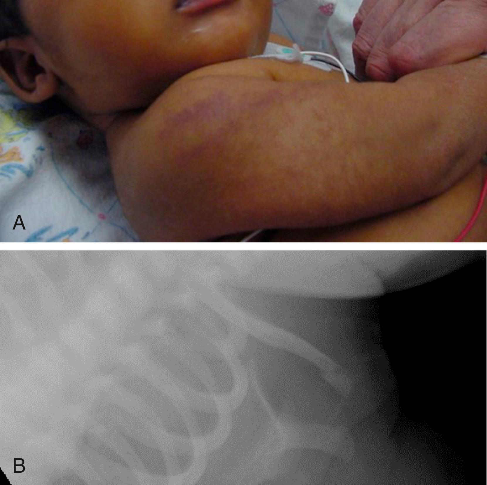 Fig. 6.32, (A) 6-month-old infant presented after being involved in a domestic dispute. Child noted to have linear bruising to both shoulders, and x-rays revealed a left distal clavicle fracture (B).