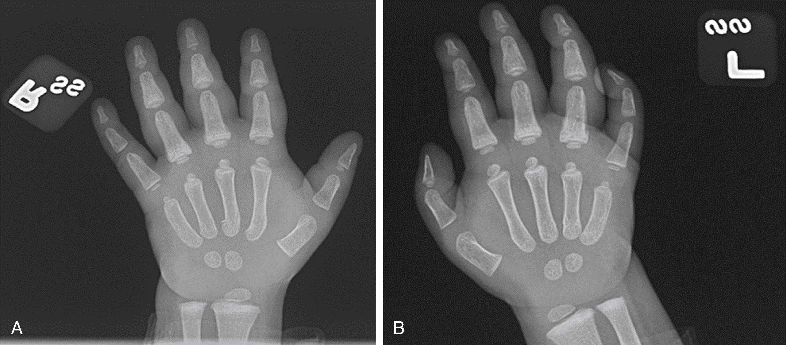 Fig. 6.33, (A and B) 18 m/o with unexplained hand swelling, brought to care multiple times. Child ultimately sent to a children’s hospital due to concern for a rheumatologic disease. Child found to have multiple acute and healing metacarpal and phalanx fractures in both hands which were diagnostic of physical child abuse.