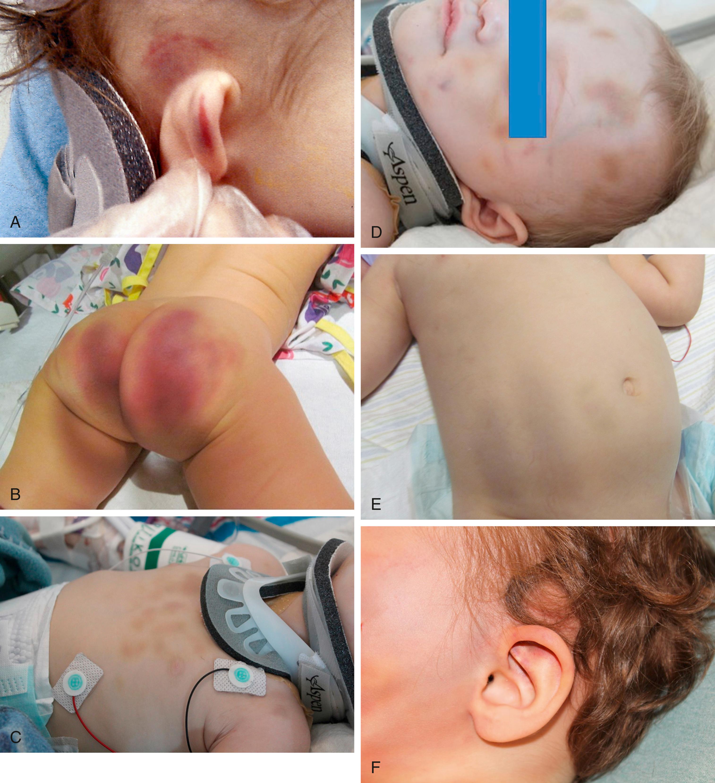 Fig. 6.4, (A) Ear bruising. This infant was hit so forcibly on the side of his head that he has an impression bruise on his scalp in the shape of his external ear. The linear bruise over the top rim of his ear is the result of capillary distortion caused by compression between the impacting hand and the child’s skull. (B) This 13-month-old was evaluated for vomiting after a reported fall from a bed. Child was found to have bilateral subdural hemorrhages, facial bruising, and this significant buttock bruising. (C-E) This battered 11-month-old was found to have bruising over nearly all surfaces of his body. Child found to have multiple acute and healing rib fractures, as well as splenic and hepatic lacerations. (F) This 21-month-old child was evaluated in an ED after a reported fall from a potty chair. Child had patterned bruising to bilateral cheeks, ear bruising, bruises to every extremity and back, as well as a transverse radius and ulnar fracture.