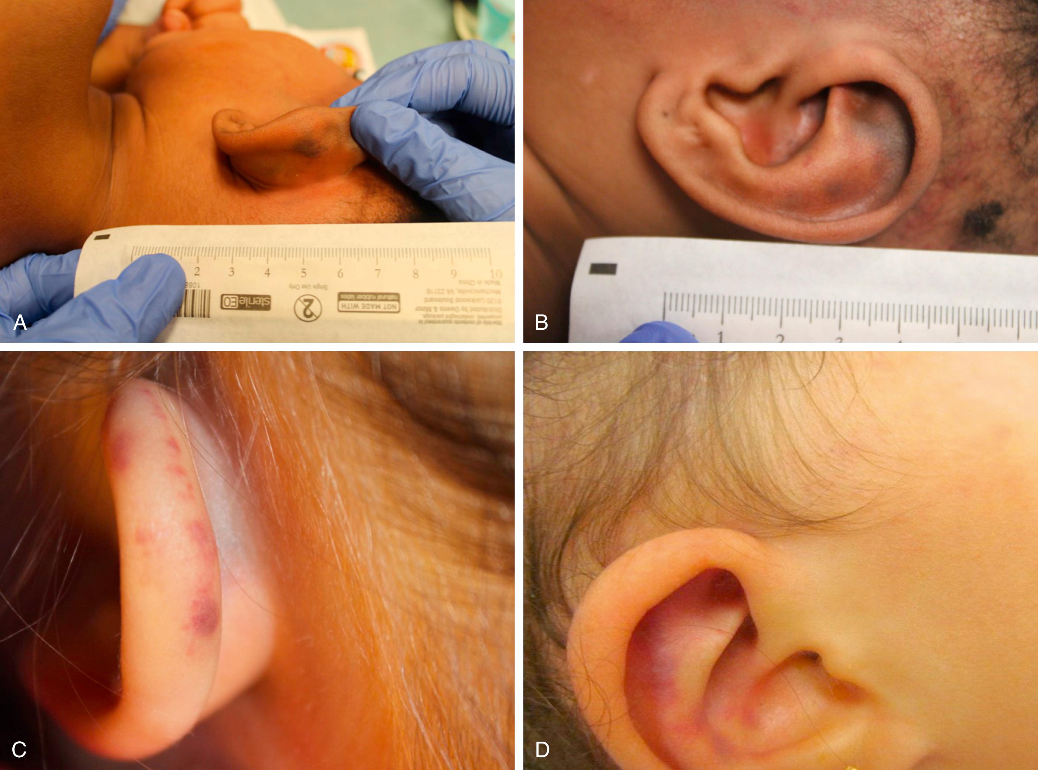 Fig. 6.7, (A) 8-month-old male who presented after an unwitnessed fall in a babysitter’s care. Child found to have an occipital skull fracture as well as bilateral ear bruising and abdominal bruising (see 6.7B). (C) 2 y/o victim of abusive head trauma found to have bilateral ear bruising and significant head and neck bruising in addition to her intracranial injuries. (D) 4-month-old infant being evaluated for vomiting. Noted to have right ear bruising, which prompted a trauma evaluation. Infant ultimately found to have bilateral subdural hemorrhages, bilateral retinal hemorrhages, as well as acute and healing rib fractures.