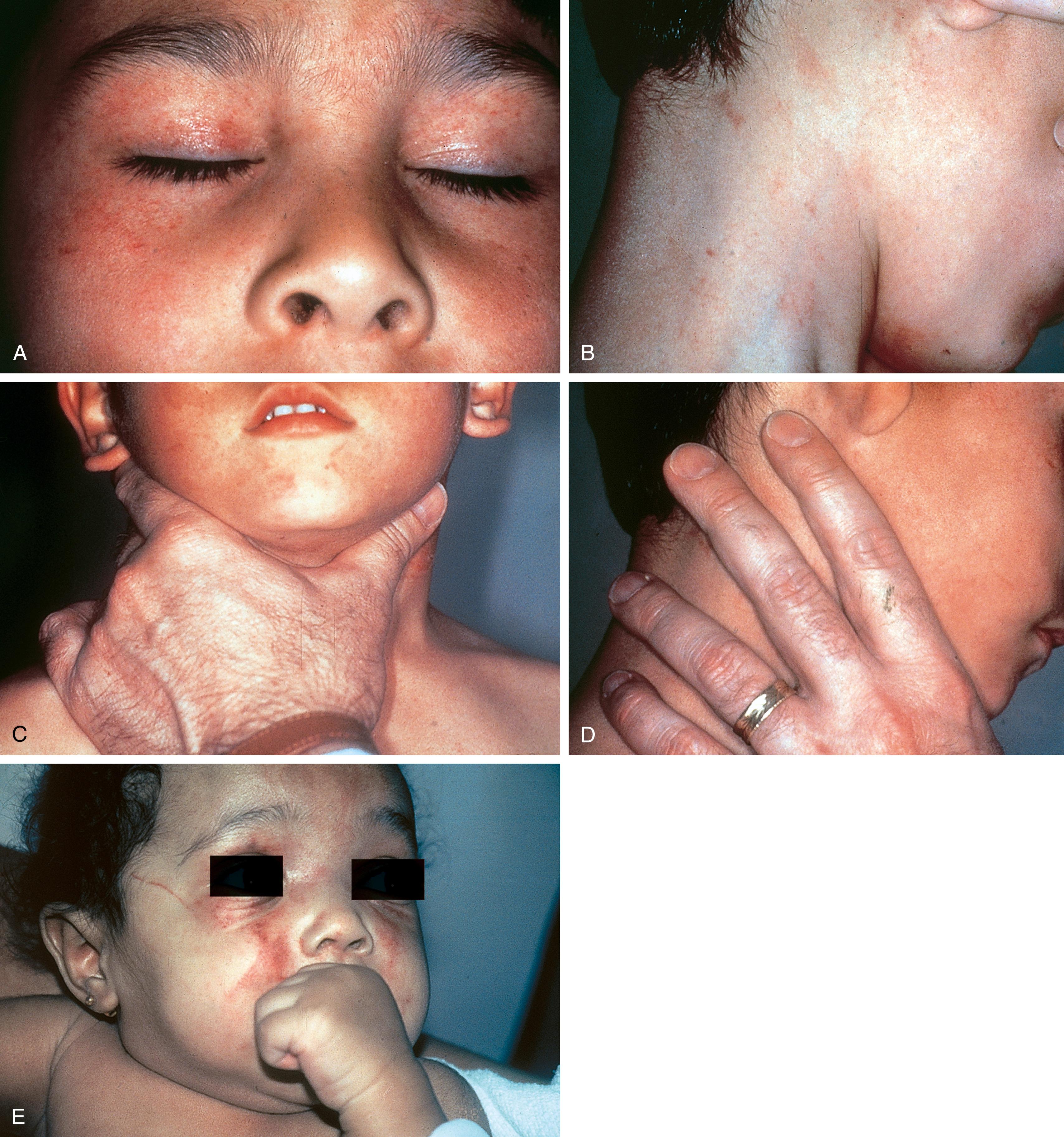 Fig. 6.8, (A–D) Petechial lesions secondary to choking. (A) Numerous petechiae are seen over this boy’s face. (B) Linear marks noted on the side of his neck correspond with the hand and finger placement demonstrated in (C and D). The boy was choked to a point of near-unconsciousness by his mother’s boyfriend for tracking grass onto a freshly vacuumed carpet. (E) Central facial petechiae were present bilaterally in this infant. The perpetrator confessed to holding his hand over her mouth and nose and squeezing her cheeks with thumb and forefinger to stop her crying.