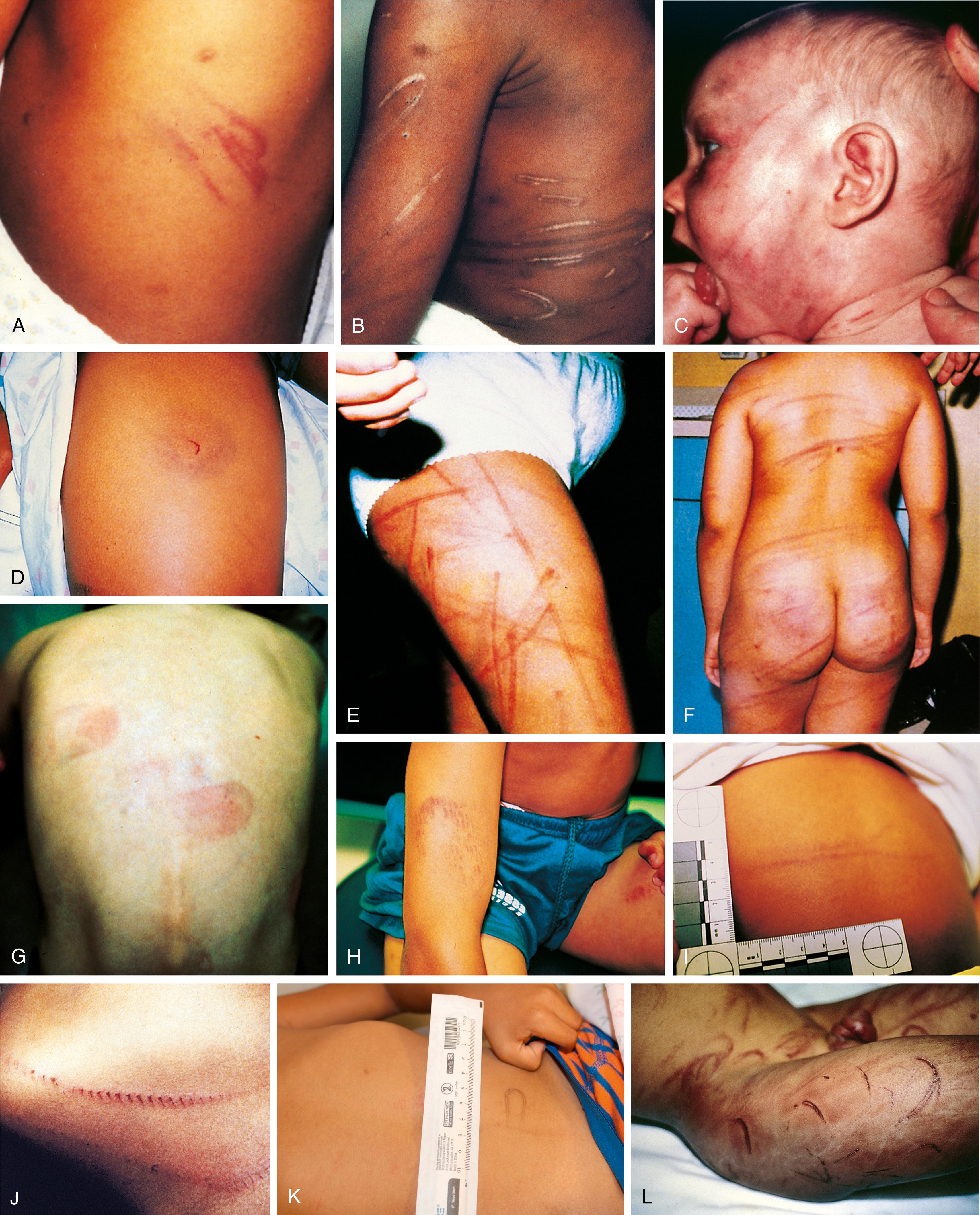 Fig. 6.10, Imprint marks reflecting the weapons used to inflict them. (A and B) Fresh looped-cord marks (A) and hypopigmented and hyperpigmented scars (B) that were the result of beatings with a looped electrical cord. (C) The characteristic pattern of parallel lines that results from blows with a belt. (D) This contusion in the configuration of a closed horseshoe with a central linear abrasion was inflicted with a belt buckle. (E) The red linear contusions on this child’s thigh were the result of repeated blows with a switch. (F) These acute linear contusions over the back and buttocks were inflicted with a belt and a switch. (G) This boy was hit with a slipper with such force that imprints of the heel are evident. (H) The heel prints of a running shoe left on this boy’s arm and thigh were distinct enough to enable identification of his abuser. (I) This girl was hit forcefully with a spatula. (J) This boy was struck with a chain, leaving a clear imprint of the links. (K) Child disclosed being hit with a phone charger, which caused this looped scar. (L) Severe bruising with underlying muscle damage. This toddler was covered from head to toe with severe looped cord contusions and lacerations. He had secondary myoglobinuria necessitating intensive care management to prevent renal failure.