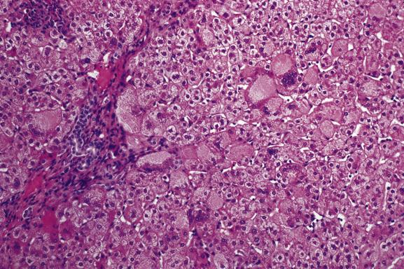 Fig. 13.1, Neonatal (giant-cell) hepatitis.