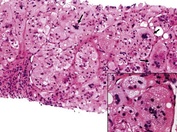 Fig. 13.2, Neonatal (giant-cell) hepatitis.