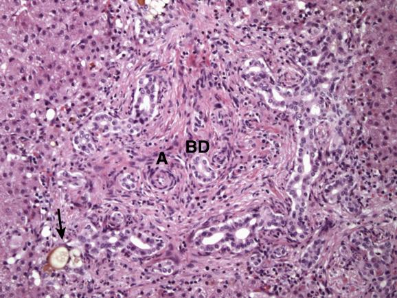 Fig. 13.3, Extrahepatic biliary atresia.