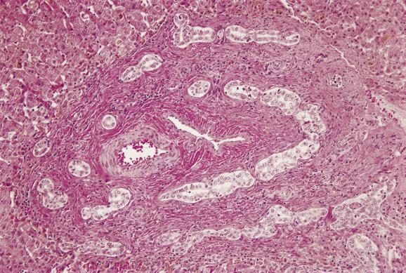 Fig. 13.4, Extrahepatic biliary atresia with bile-duct plate-like structures.