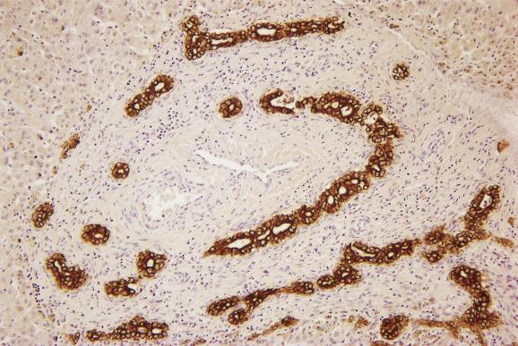 Fig. 13.5, Extrahepatic biliary atresia with bile-duct plate-like structures.