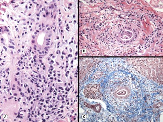 Fig. 13.6, Autoimmune sclerosing cholangitis.