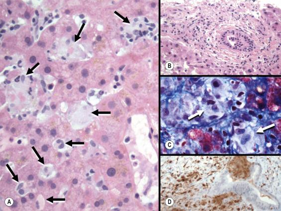 Fig. 13.7, Langerhans cell histiocytosis involving the liver, with evolving features of sclerosing cholangitis.